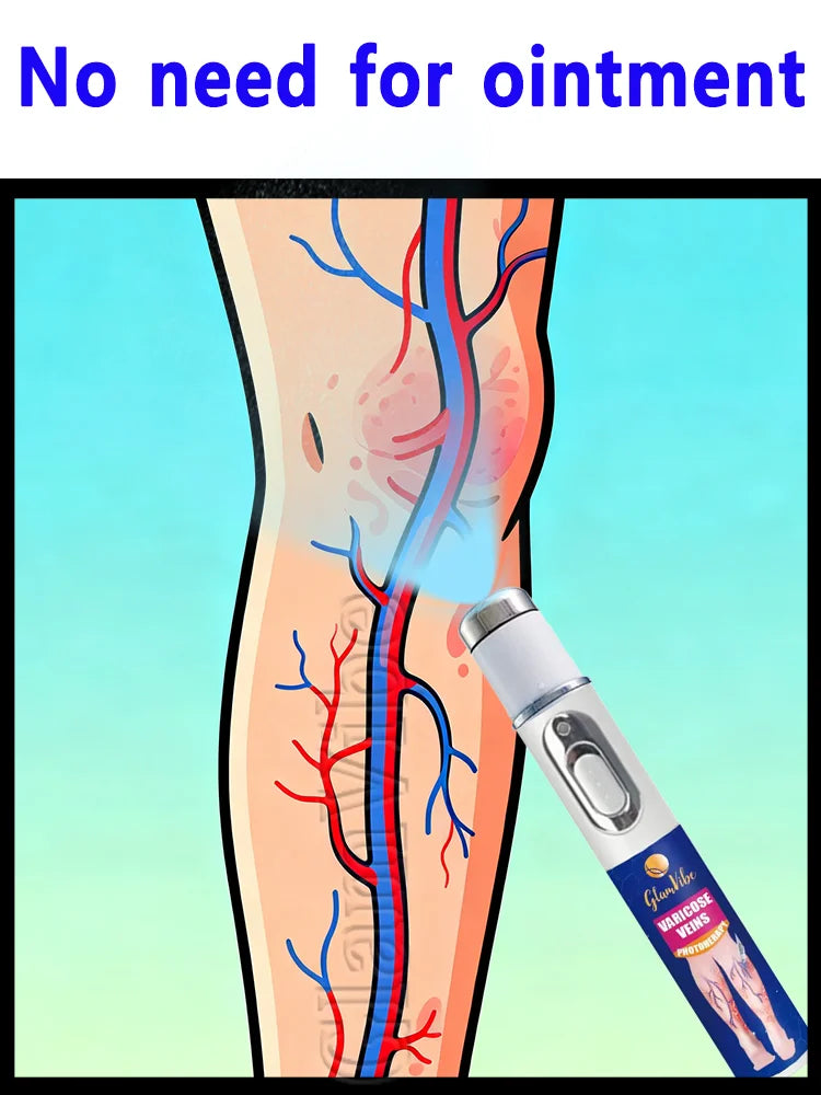 The second-generation laser says goodbye to spider leg veins in 7 days