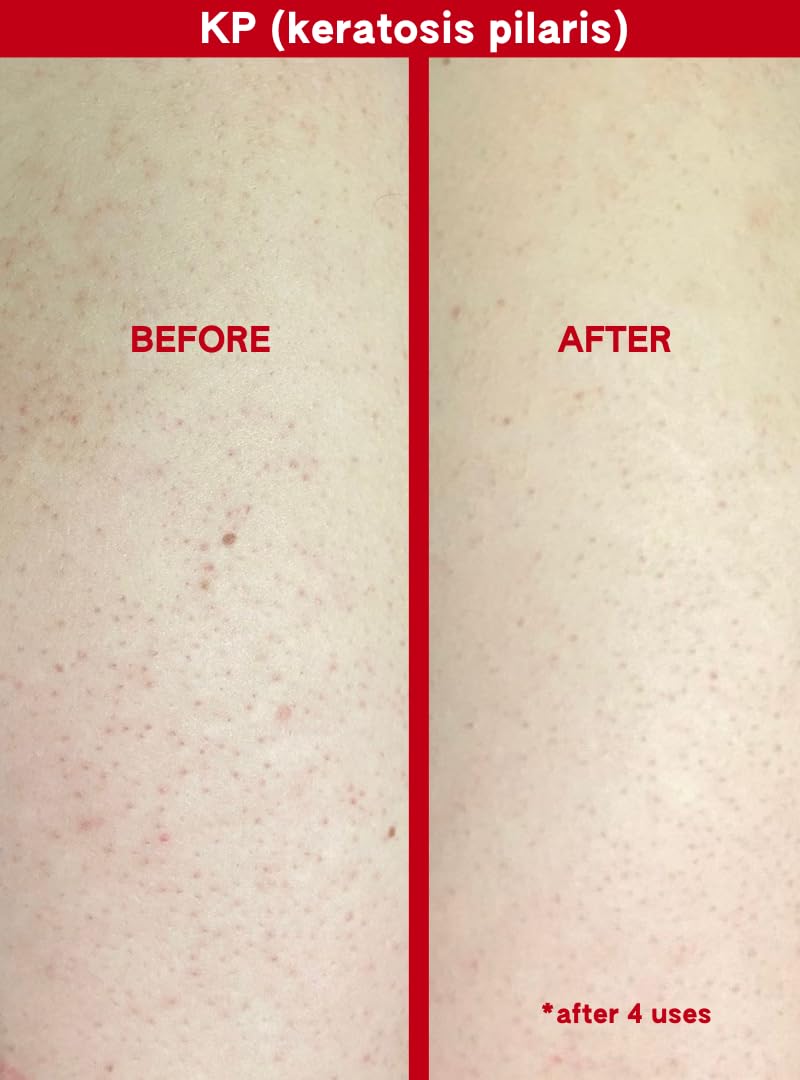 ABI AME Chemical Body Exfoliator – 30% AHA & 2% BHA | Pre-Shower Body Mask 150 ml