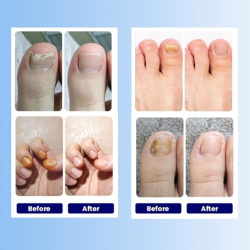 Aedydyce Toenail Fungus Treatment Extra Strength - 21 Patches