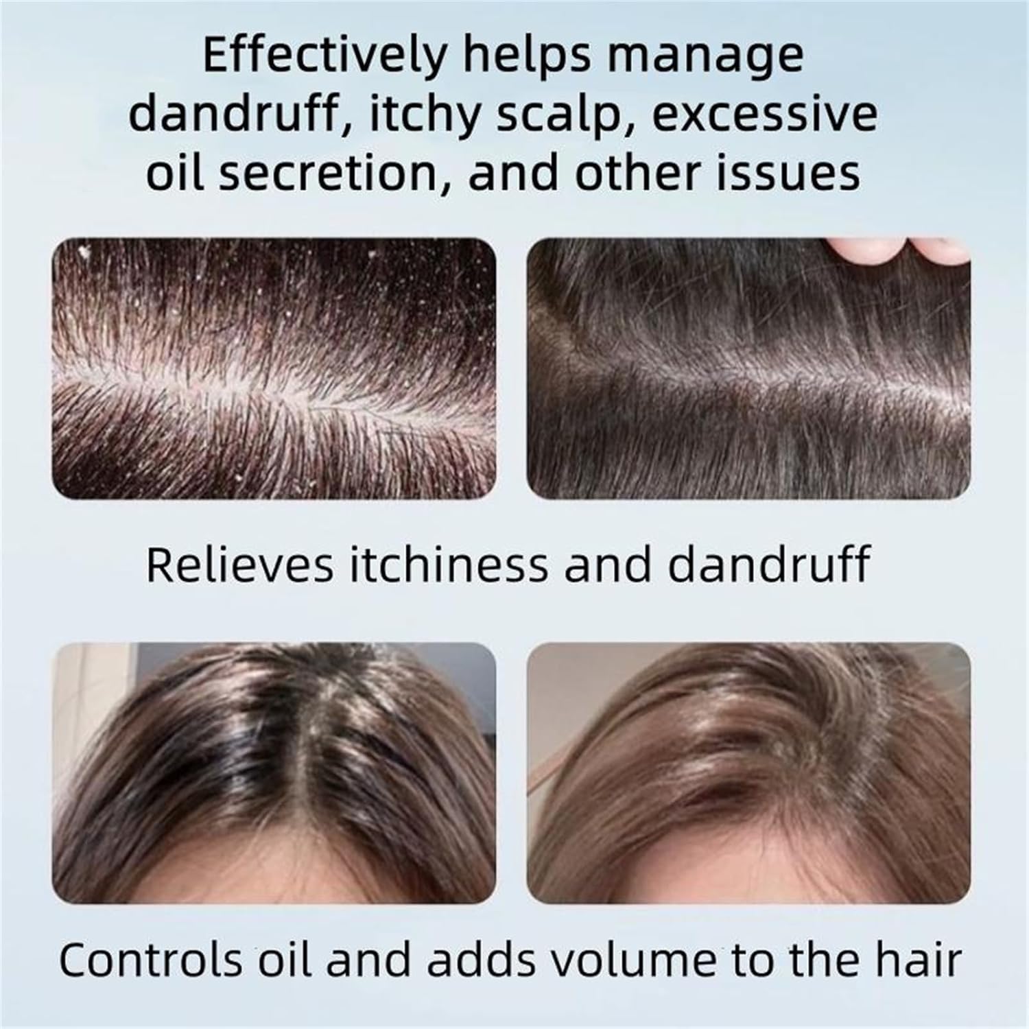 10.55 fl oz Anti-Dandruff Shampoo – Oil Control for All Hair Types (Men & Women)