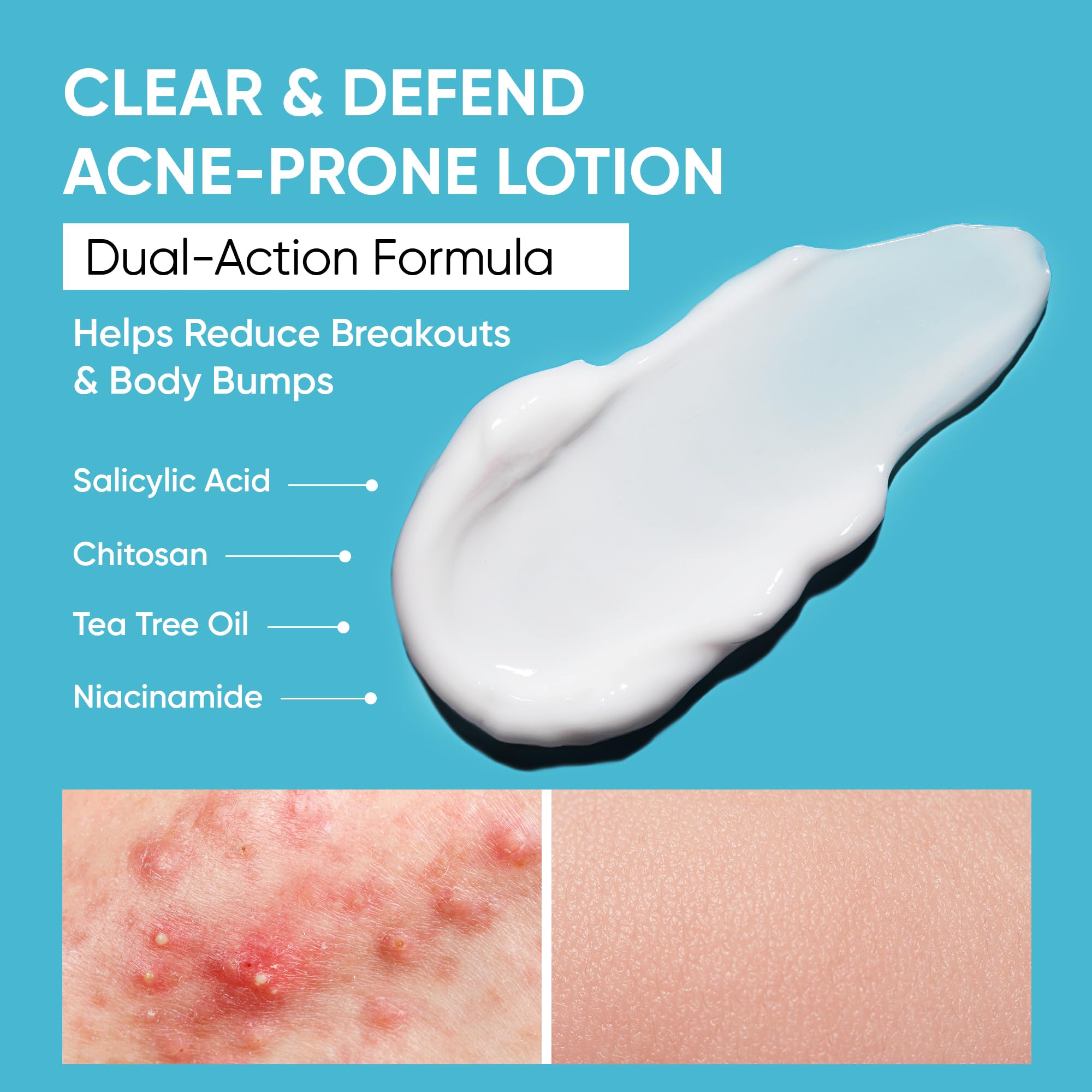 AOBBIY Butt Acne Clearing Treatment Cream — 2% Salicylic Acid & Niacinamide for Back, Butt & Body