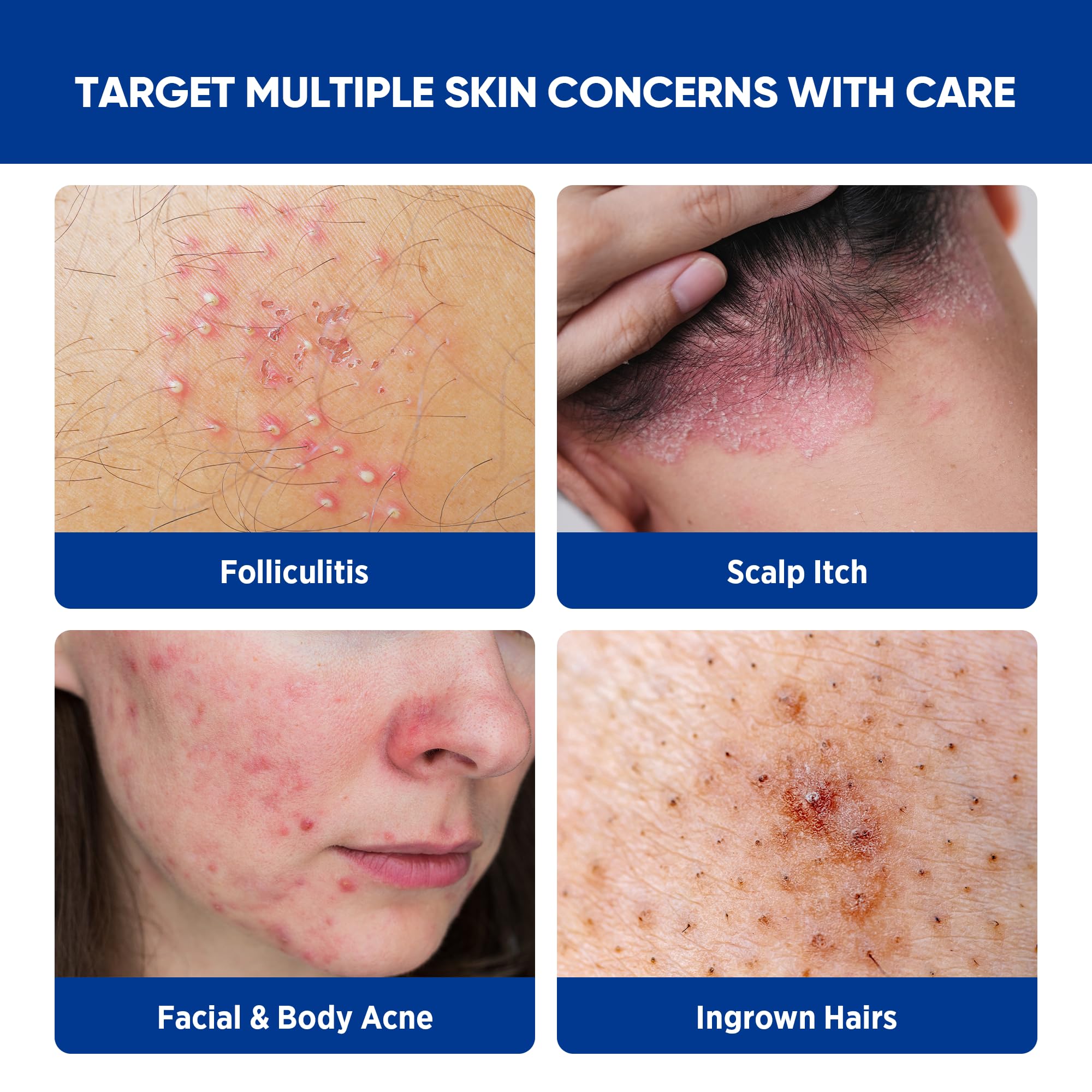 AOSORW Folliculitis & Acne Treatment Cream – 1% Salicylic Acid & Herbal Extracts, 100g