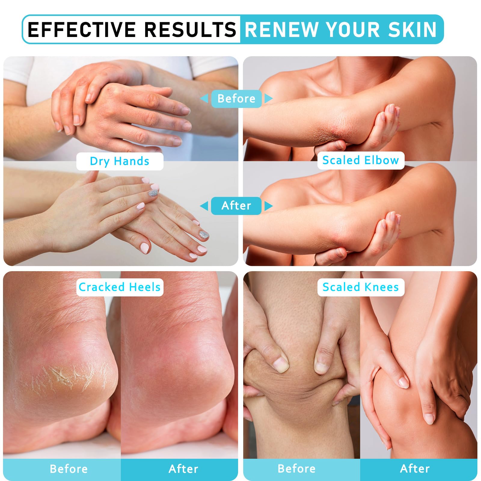 Aphesia Urea Cream 40% Maximum Strength — Foot & Body Moisturizer with Vitamin E & Salicylic Acid