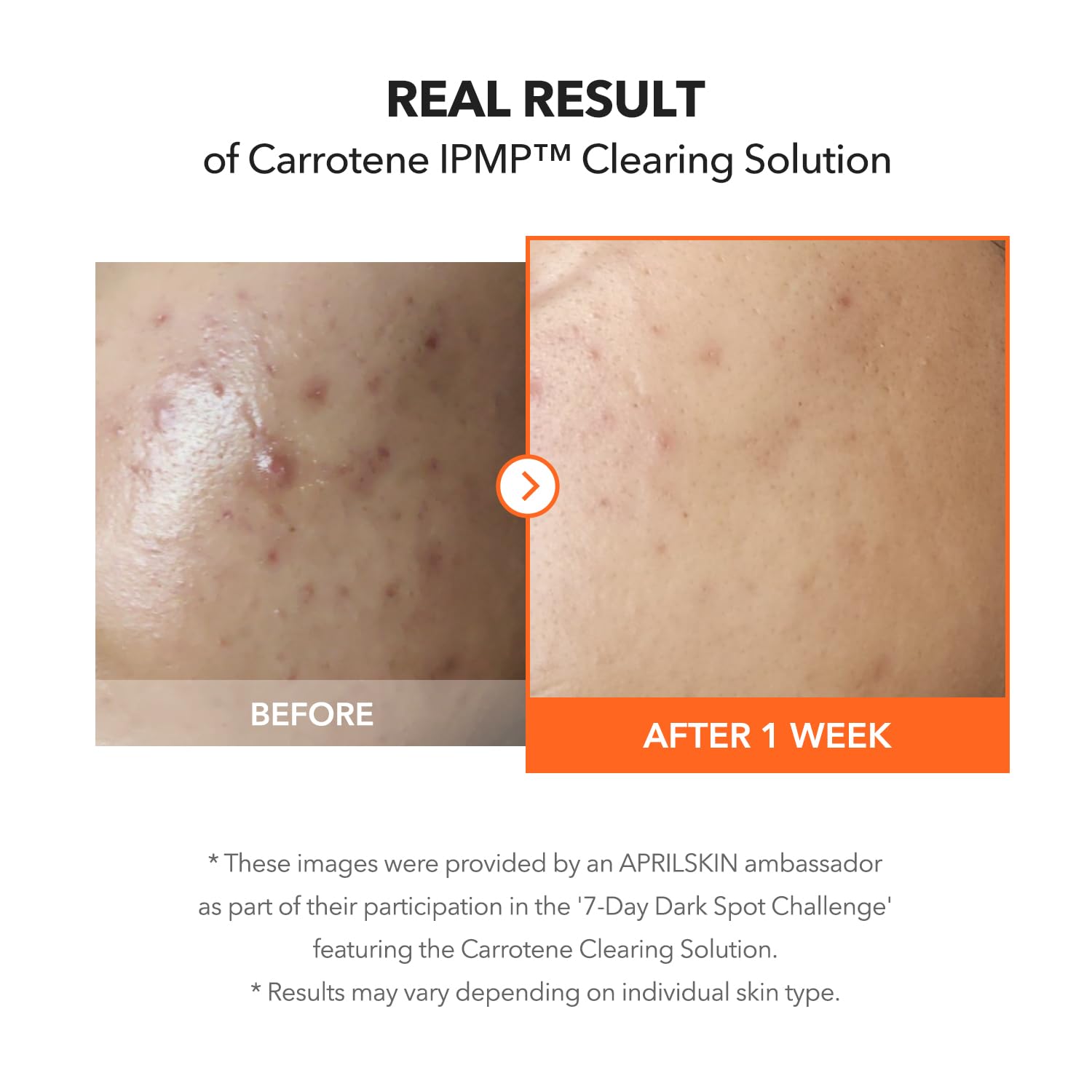 APRILSKIN Carrotene IPMP Clearing Solution | Quick Blemish Calm, 0.67 fl oz, Vegan
