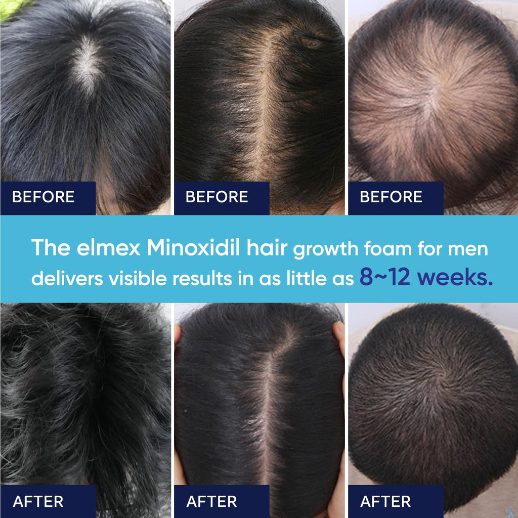 Artimore 5% Minoxidil Foam for Hair Growth – For Men & Women, 6 oz