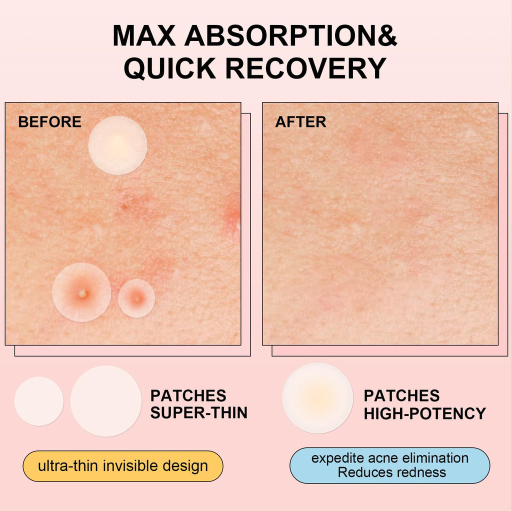 AVJONE Pimple Patches for Face – Hydrocolloid Acne Patches with Tea Tree Oil (144 Patches)