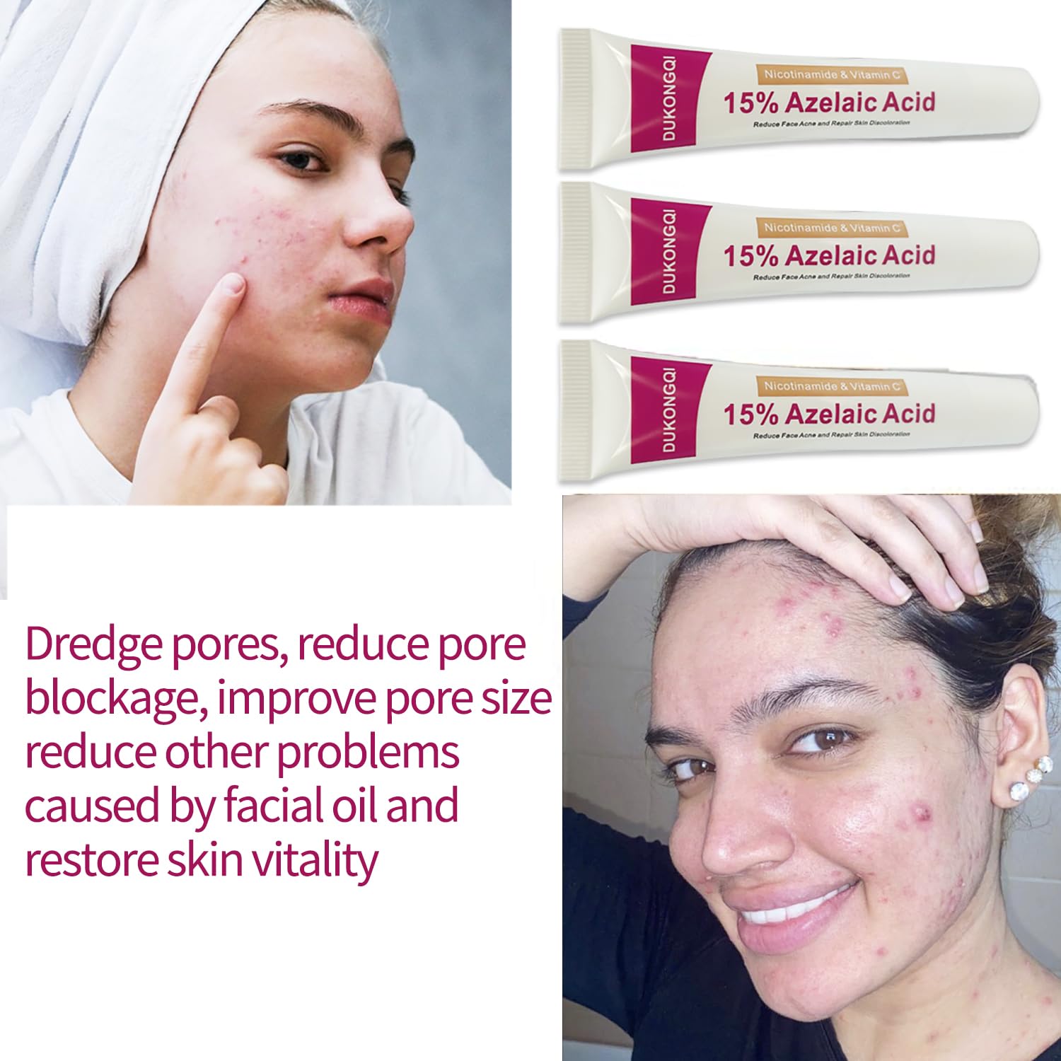 Azelaic Acid Serum for Balanced Skin Tone & Clear Pores – Acne & Redness Relief, 20g