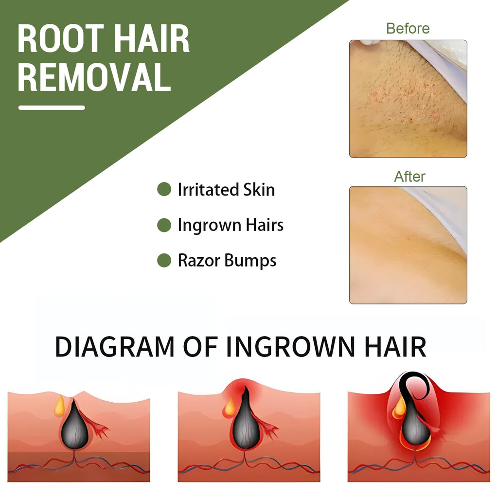 Bapbalolo Ingrown Hair Patch — 30 Patches for Bikini Area, Gentle Non-Irritating Formula