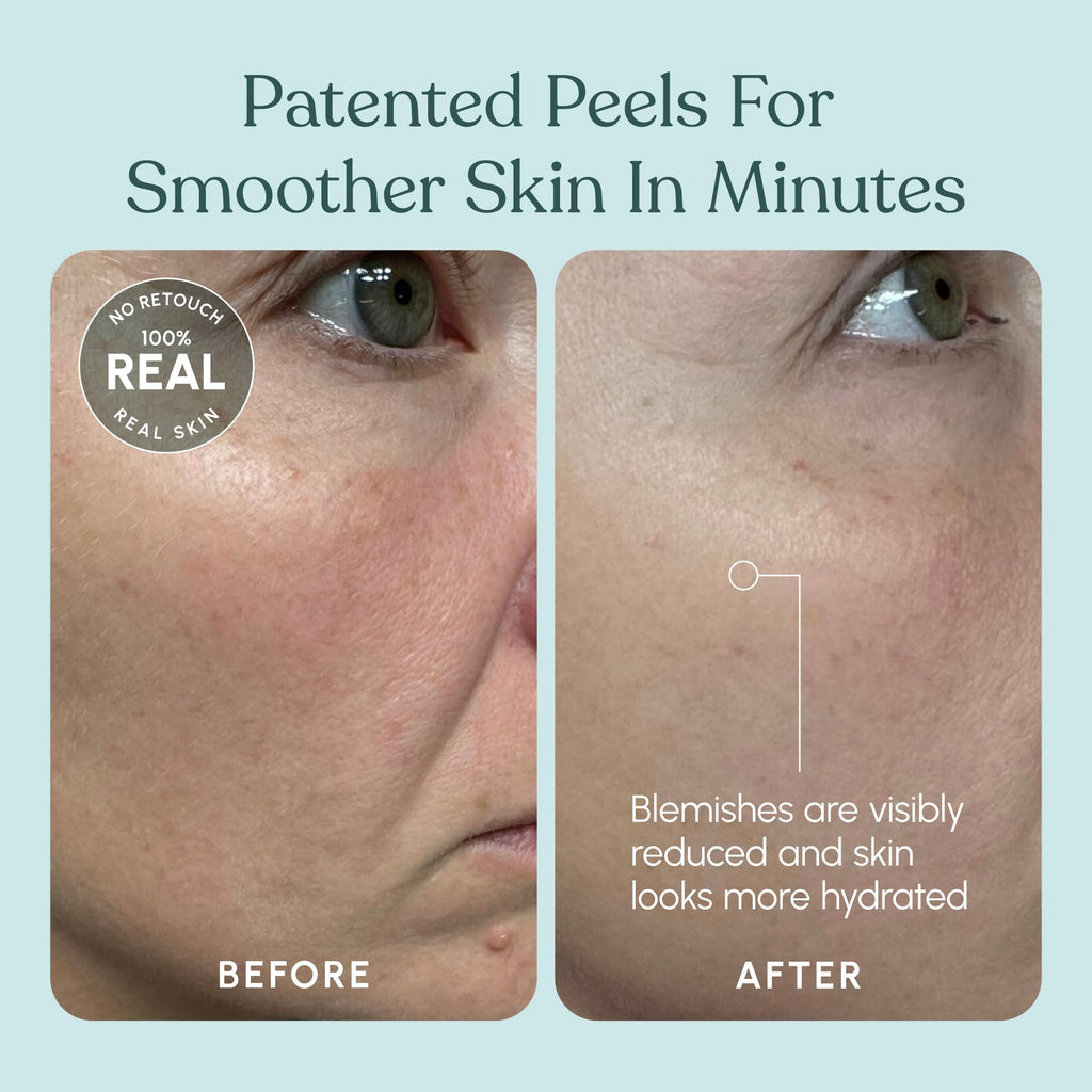 Beautiste 30 Day Miracle AHA 30% + BHA 2% Peel – Pore Refining Exfoliant