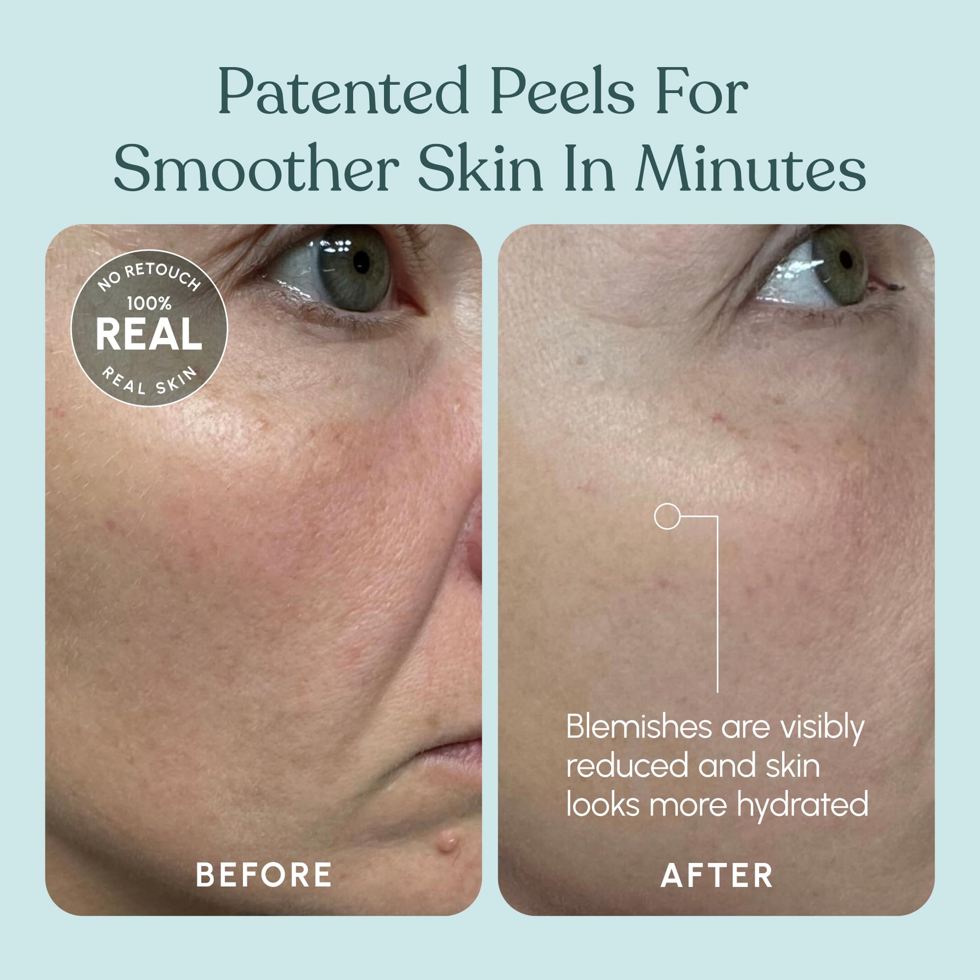 Beautiste 30 Day Miracle AHA 30% + BHA 2% Peel – Pore Refining Exfoliant