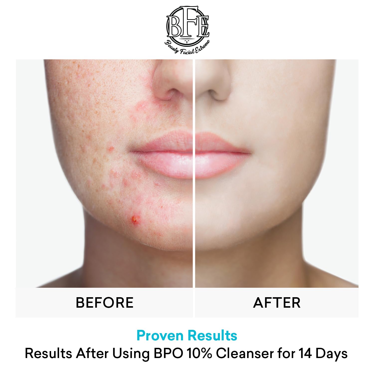 Beauty Facial Extreme Acne Face Wash 10% Benzoyl Peroxide – Deep Cleansing for Oily Skin & Breakouts