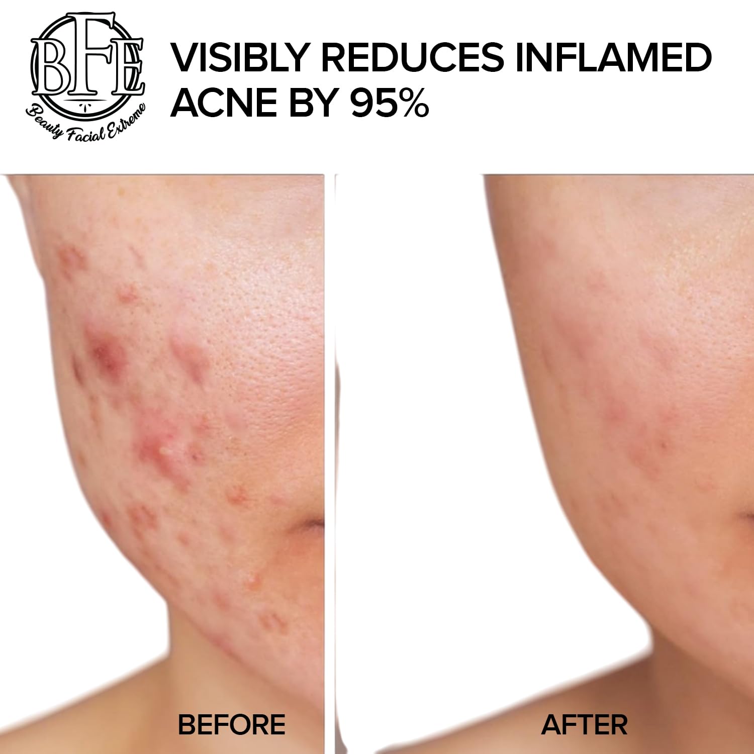 Beauty Facial Extreme Acne Treatment Pads – Clear Pimples, Oily Skin & Pores