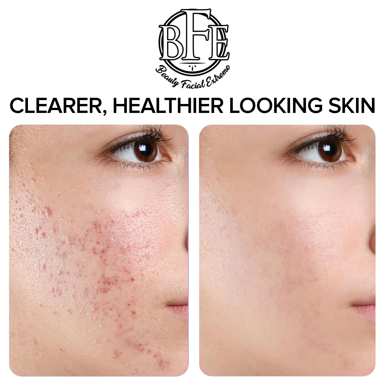 Beauty Facial Extreme Acne Treatment Pads – Clear Pimples, Oily Skin & Pores