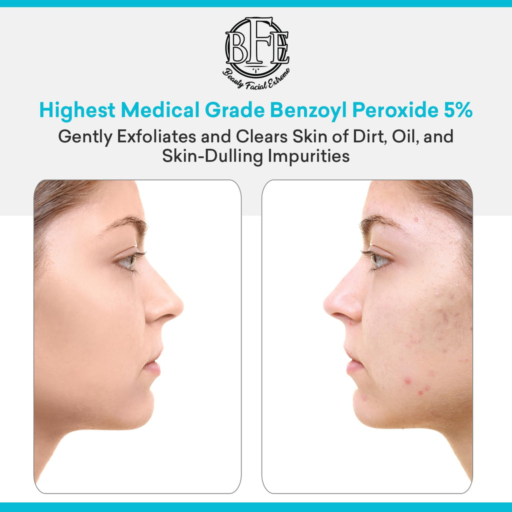 Beauty Facial Extreme Acne Wash 10% Benzoyl Peroxide – Clear Skin for Oily, Acne-Prone Skin