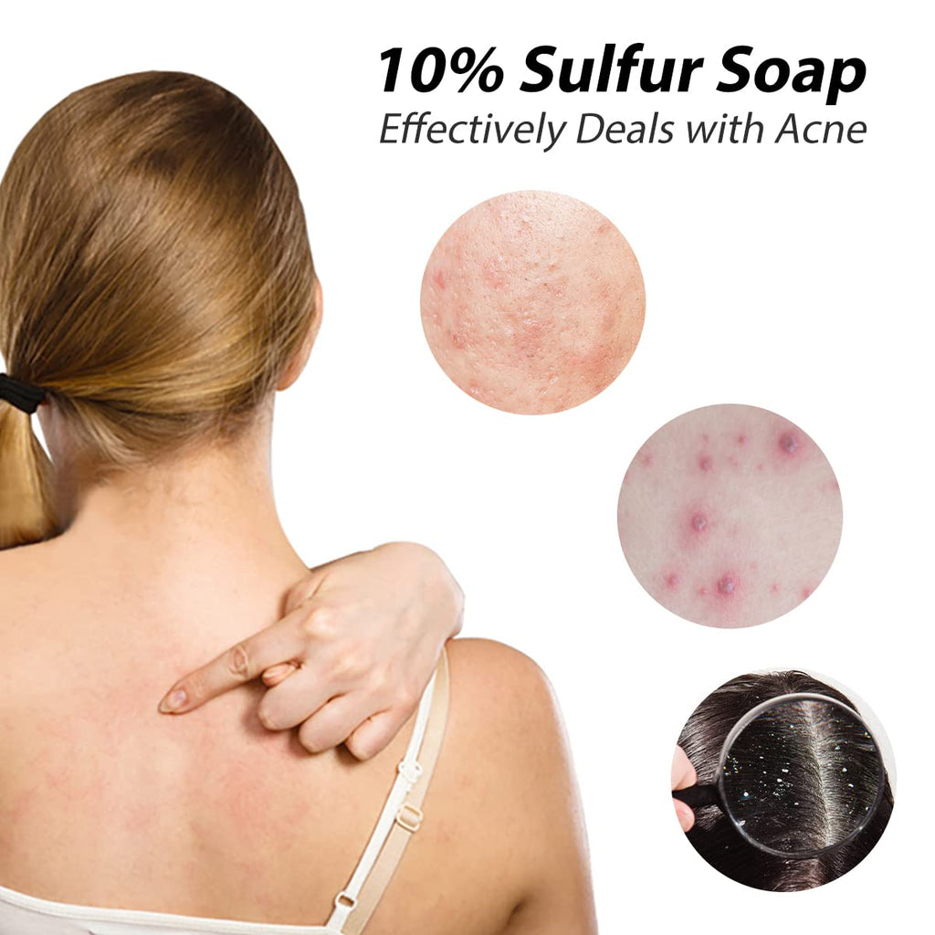 Bee & Flower Shanghai Sulfur Soap 10% – Acne Treatment Bar, 3.4 Oz, 6-Pack