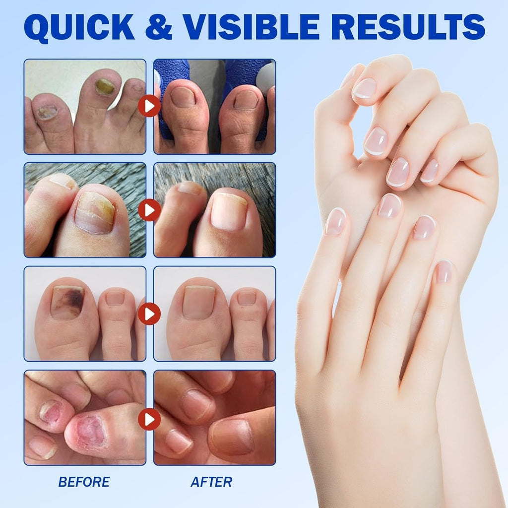 BOELIKAYS Fungal Nail Patches - Extra Strength Toenail Treatment
