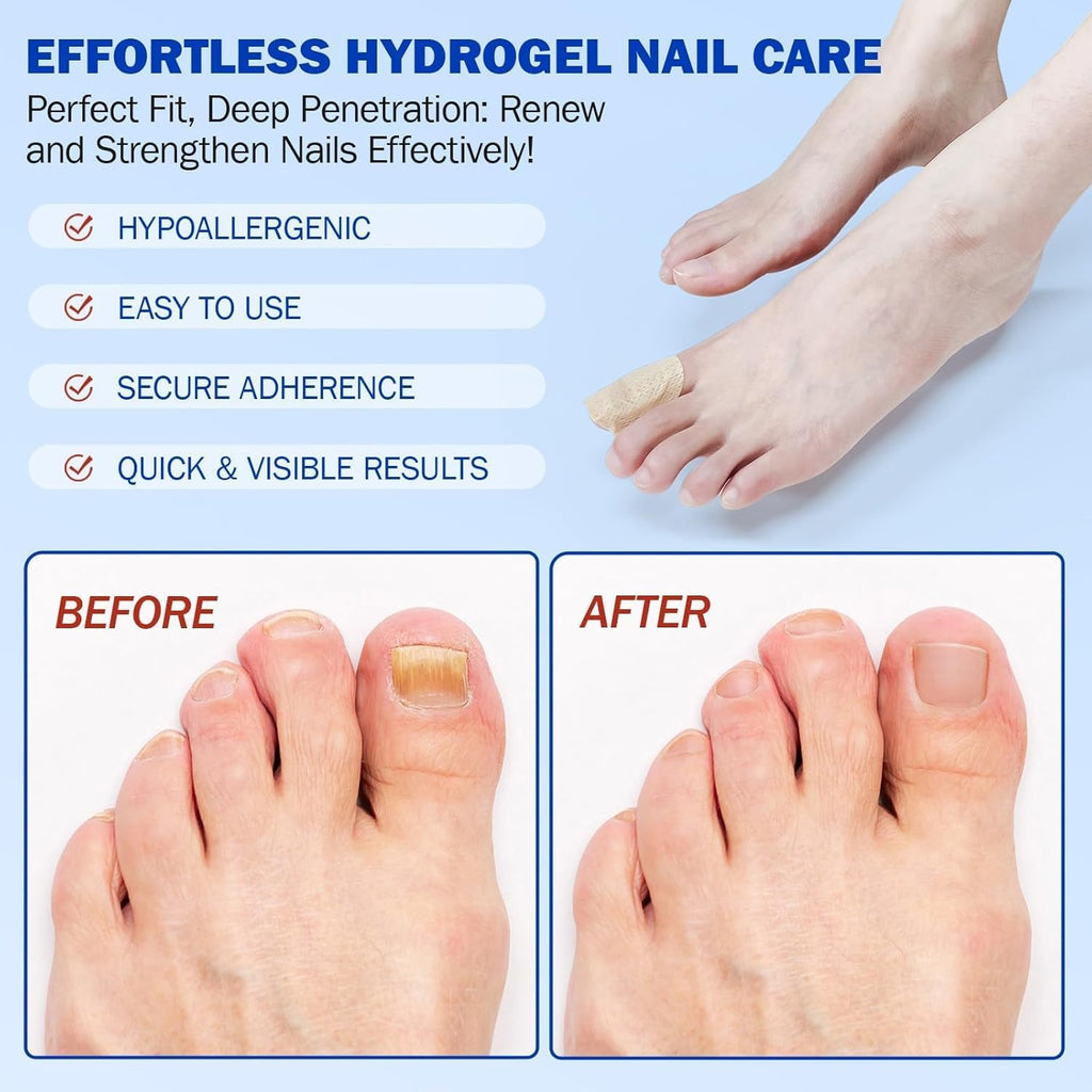 BOELIKAYS Fungal Nail Patches - Extra Strength Toenail Treatment