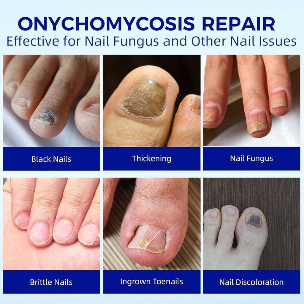BOELIKAYS Fungal Nail Patches - Extra Strength Toenail Treatment