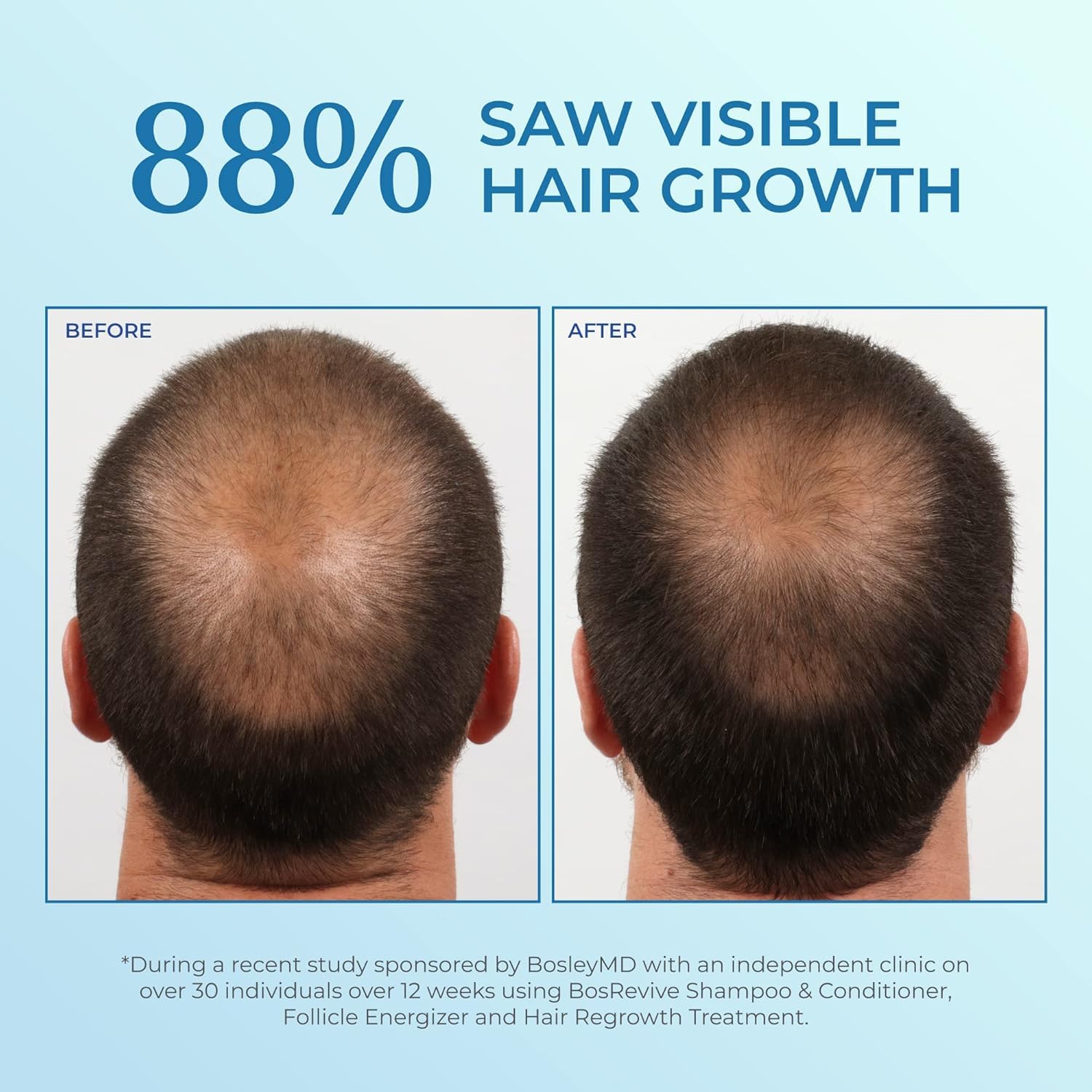 BosleyMD Minoxidil Foam 5% – Extra Strength Hair Regrowth Treatment (2 oz, 1-Month Supply)