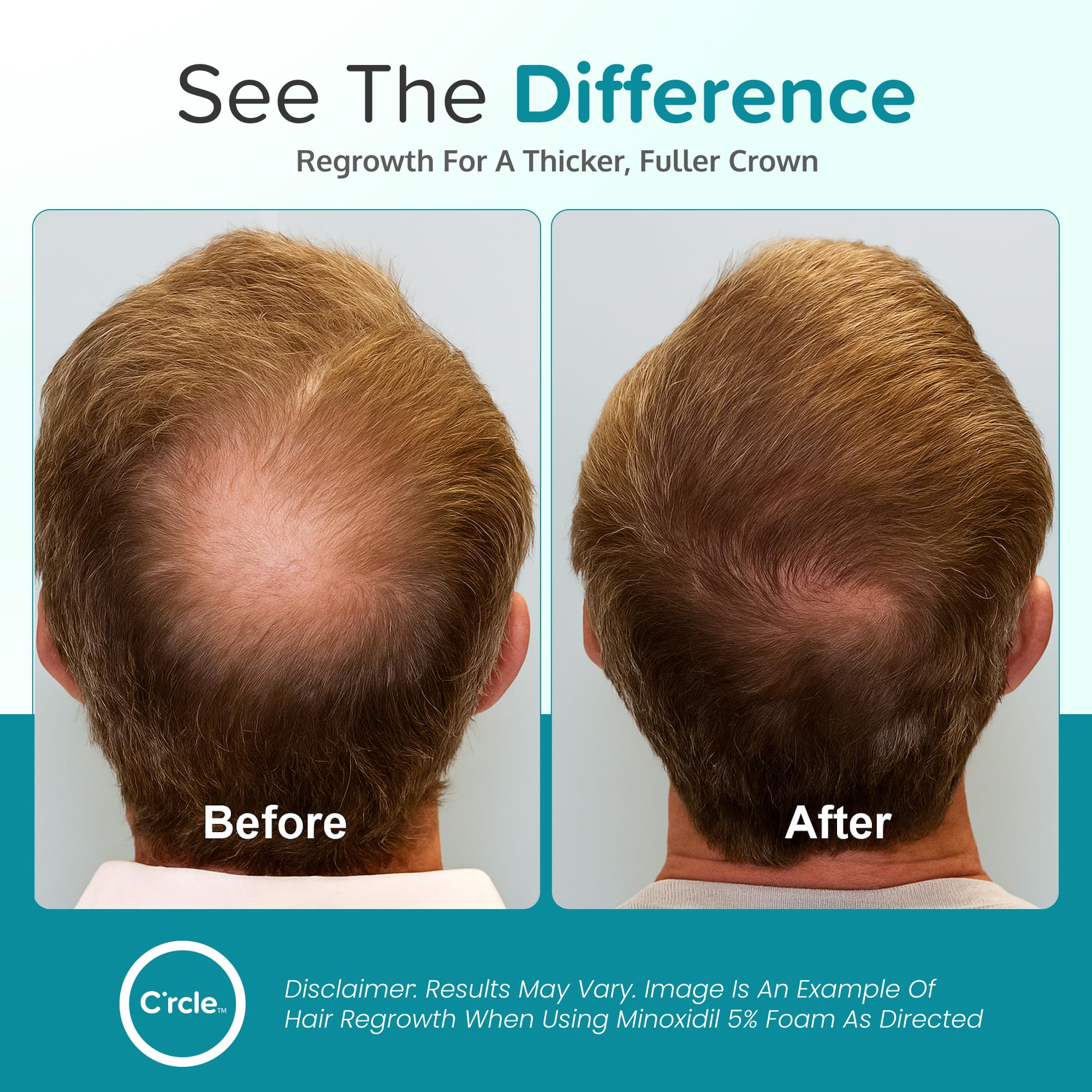 C'rcle Minoxidil 5% Foam for Men – Unscented, 3-Month Supply | Vertex Hair Loss & Thinning Support