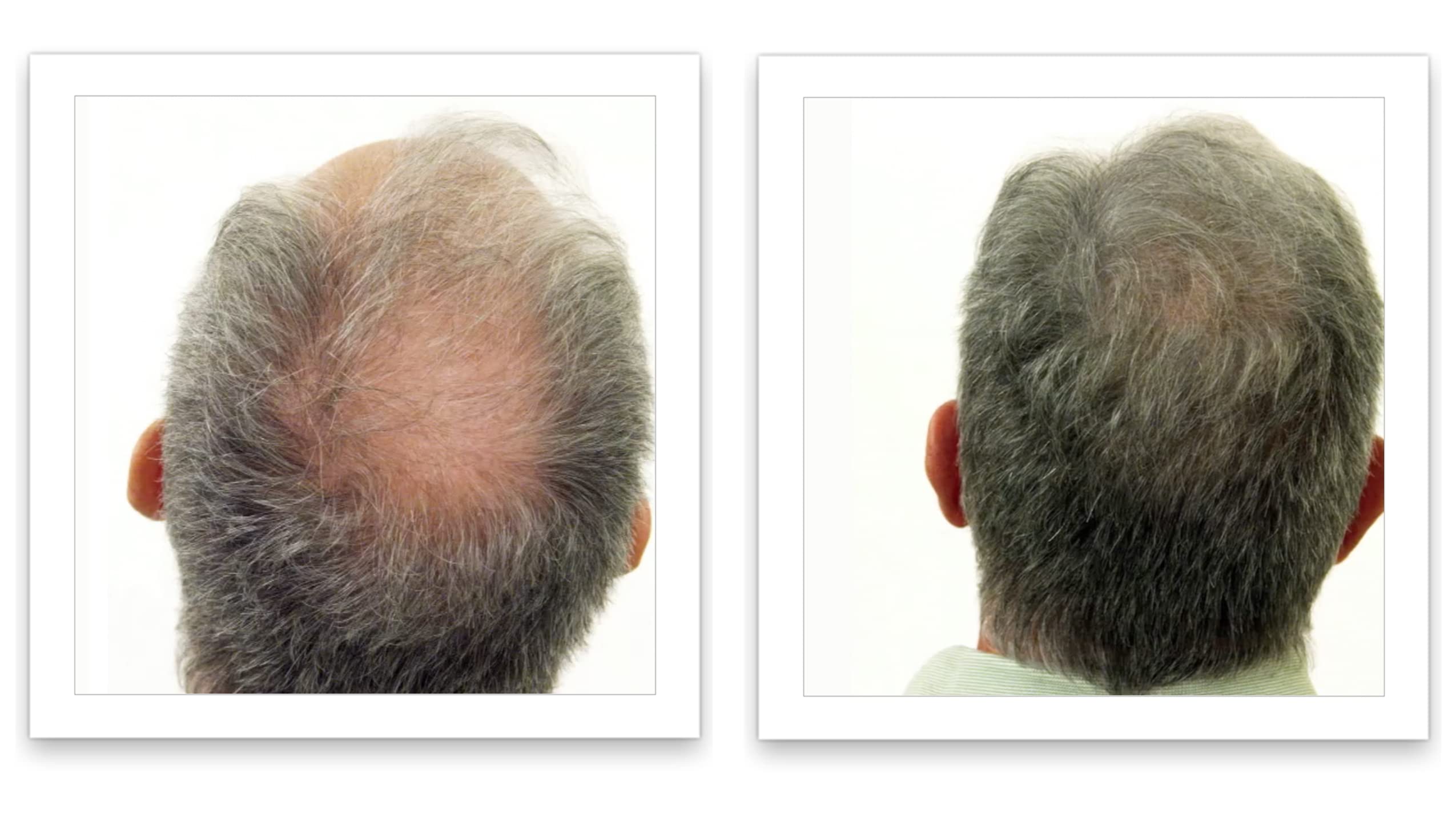 Caboki Hair Loss Concealer — All-Natural Fibers for Instant Fuller Hair (30g, 90-Day Supply) Salt & Pepper - Light