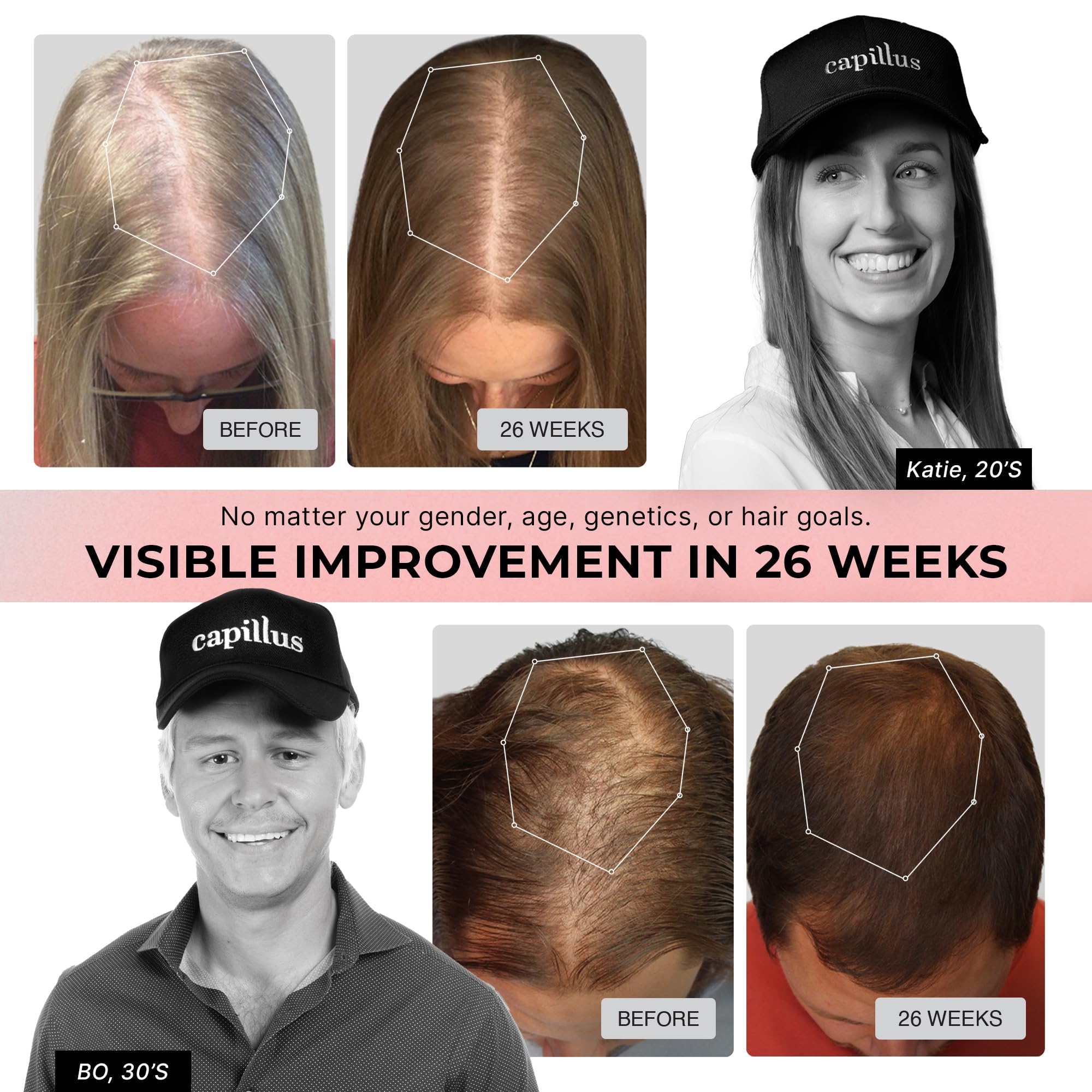 Capillus Pro S1 Red Light Therapy Cap for Hair Growth | FDA-Cleared LLLT