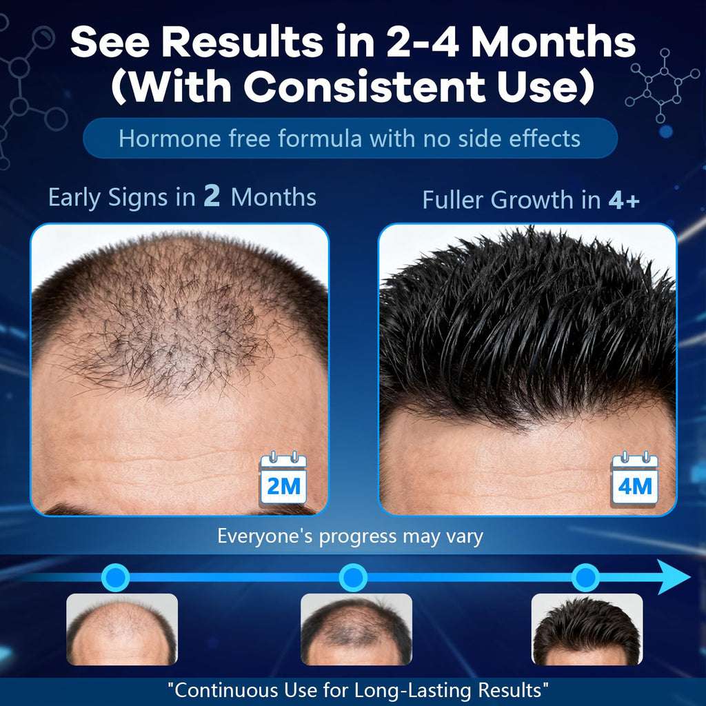 CARENICE 5% Minoxidil Foam for Men with Biotin – Unscented Hair & Beard Growth (6.33 oz)