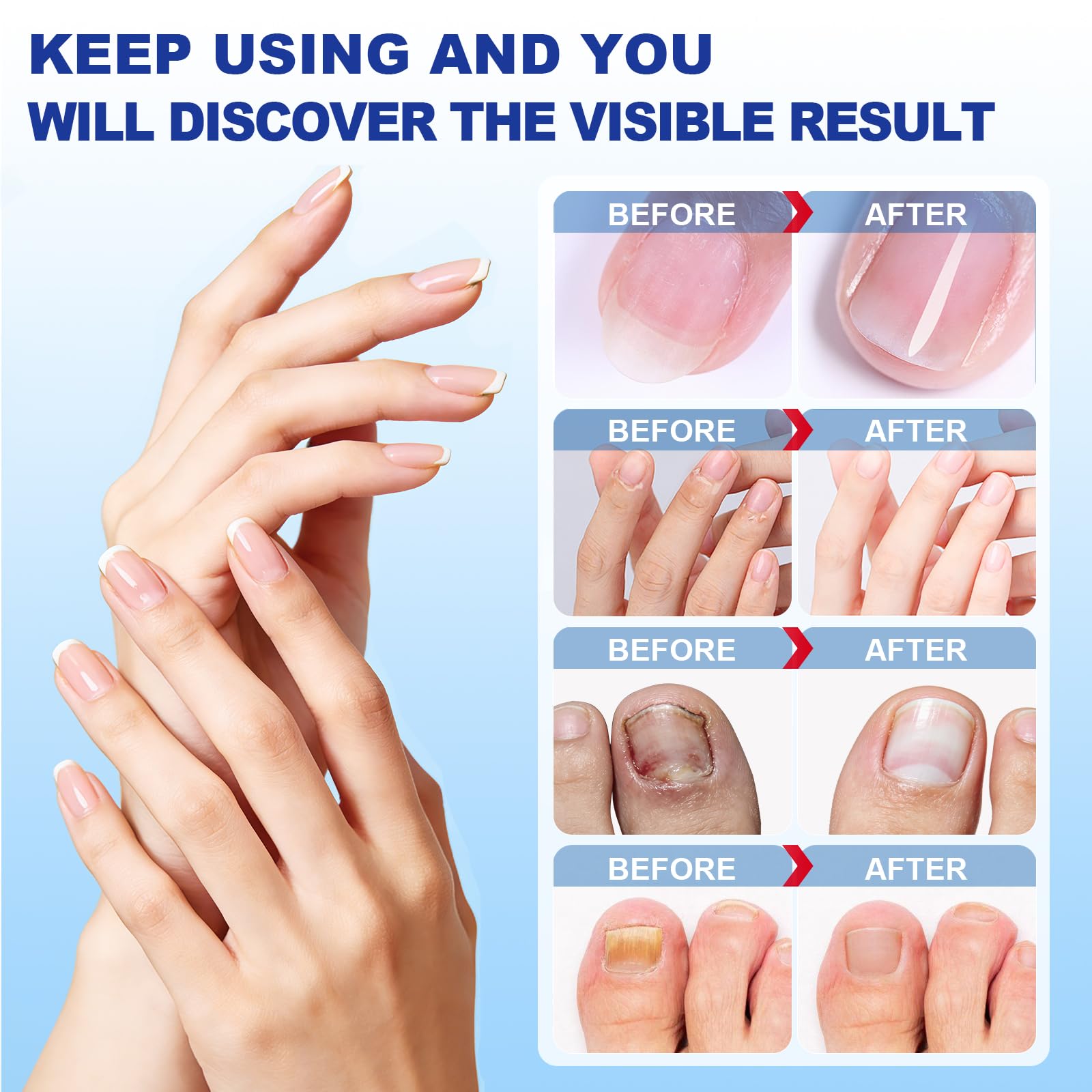 CauseYouLove Nail Patches for Toenails - 2-Pack, 8-Hour Overnight Care, 42 Count