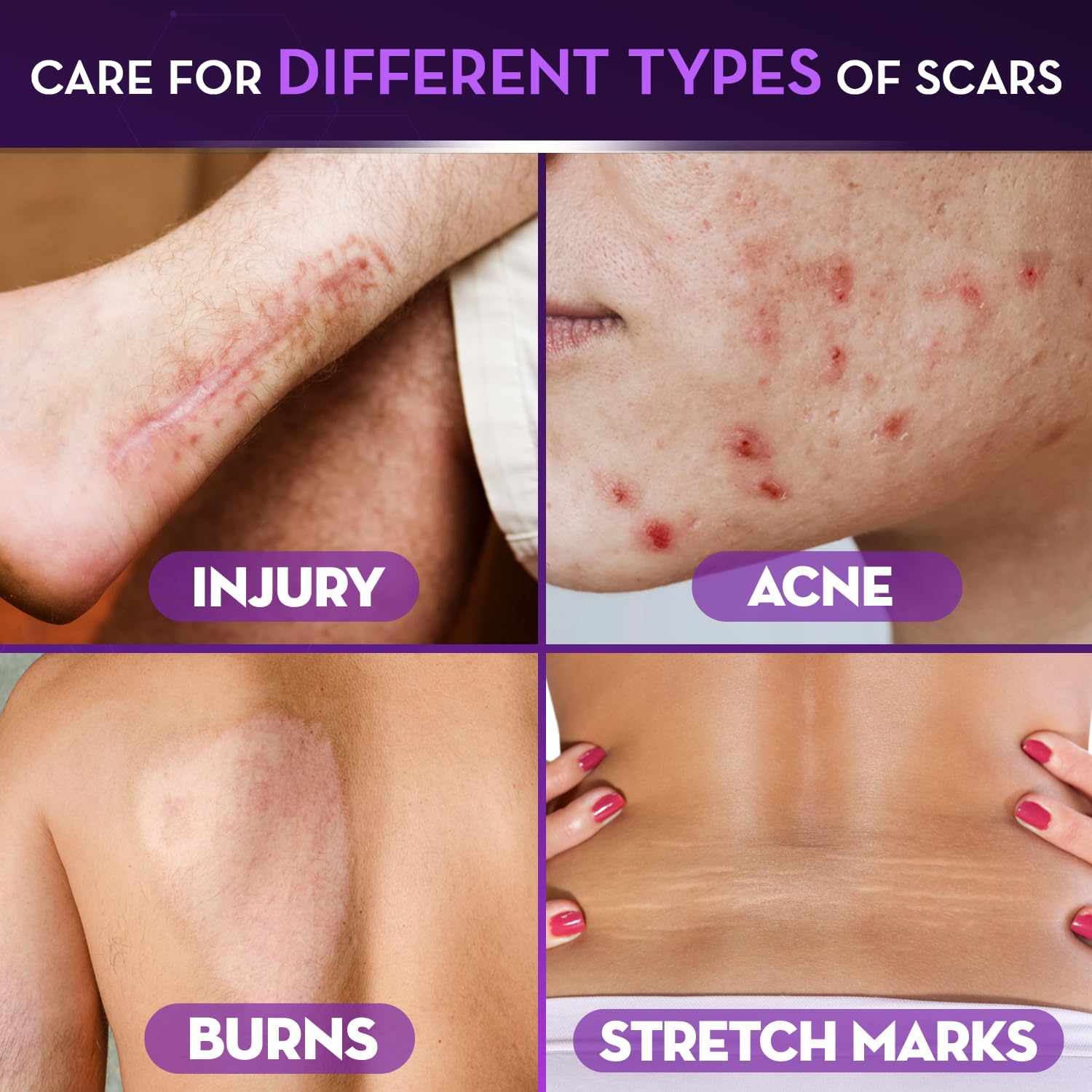 Cicatricure Advanced Scar Gel for Face & Body – Clinically Proven Results in 2 Weeks
