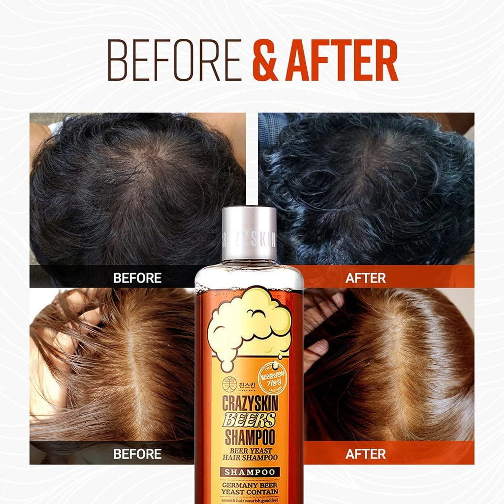 Crazy Skin German Beers Shampoo 2x300ml – Biotin & Beer Yeast for Regrowth & Thickening | Sulfate-Free