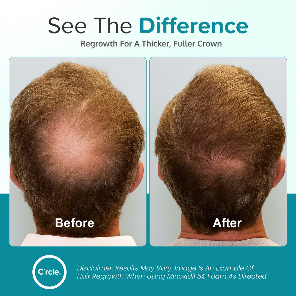 C'rcle Minoxidil for Men Foam 5% - Unscented, 6-Month Supply