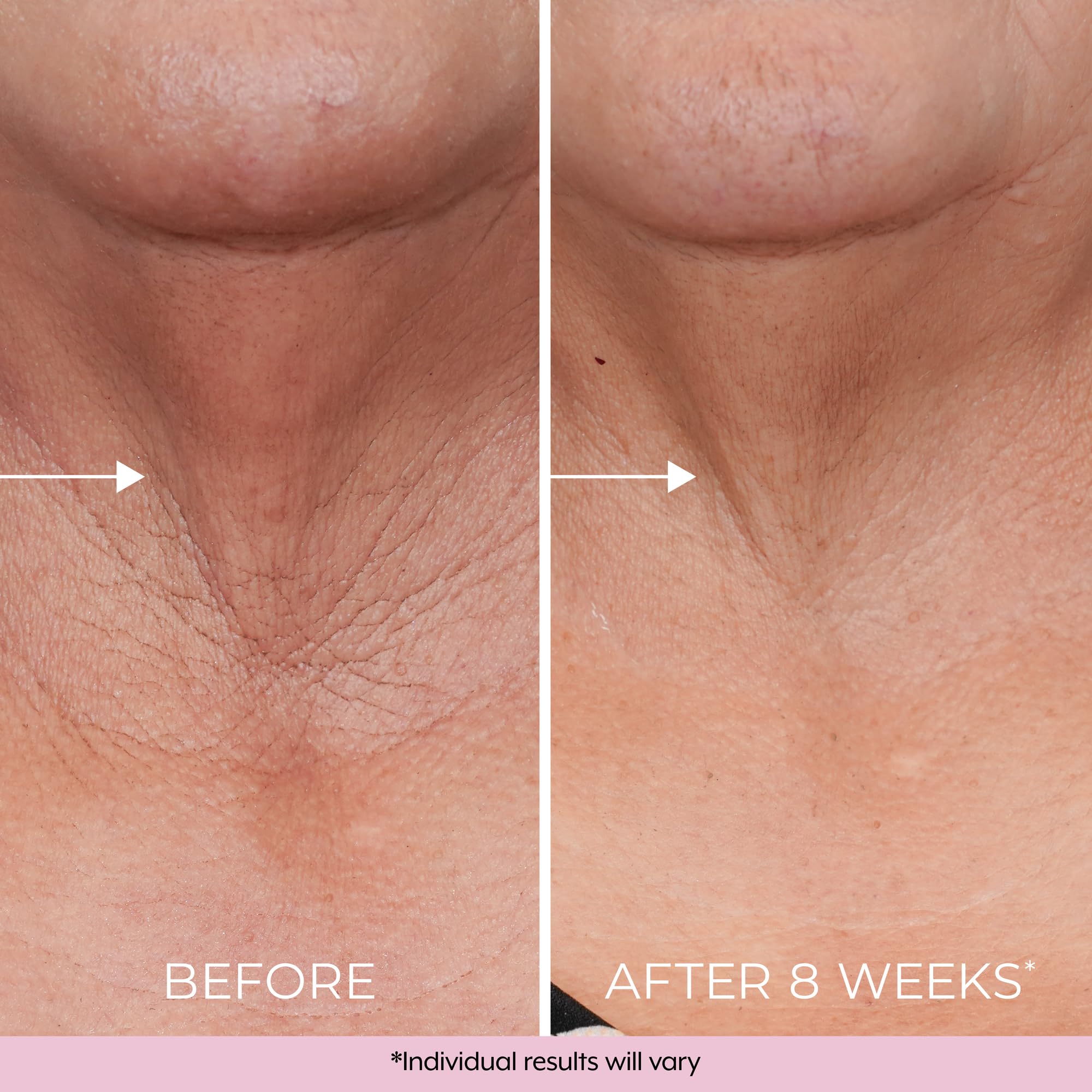 DEKLIDERM Neck Firming Cream – Retinol & Bakuchiol for Neck Lines & Firmness