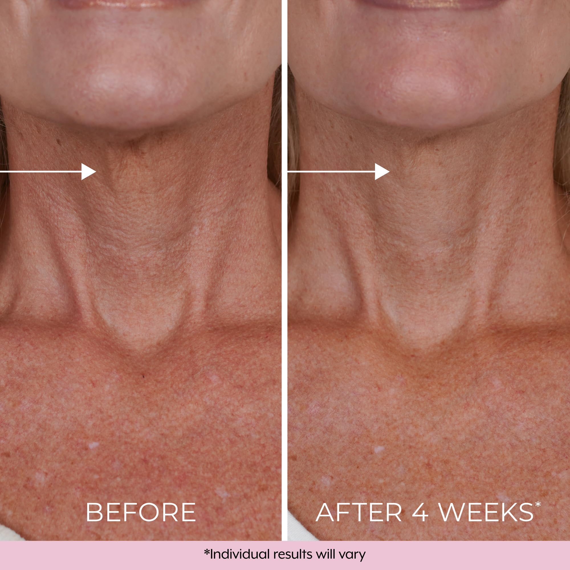 DEKLIDERM Neck Firming Cream – Retinol & Bakuchiol for Neck Lines & Firmness