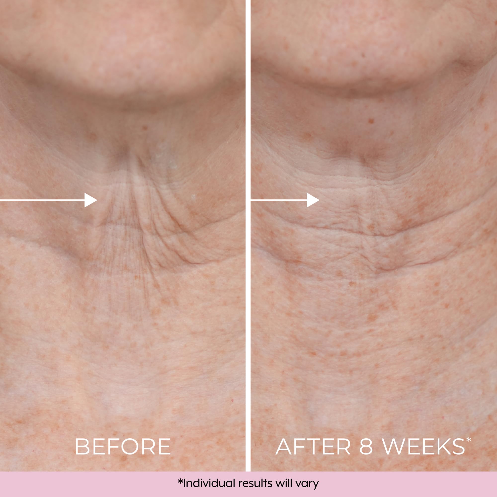 DEKLIDERM Neck Firming Cream – Retinol & Bakuchiol for Neck Lines & Firmness
