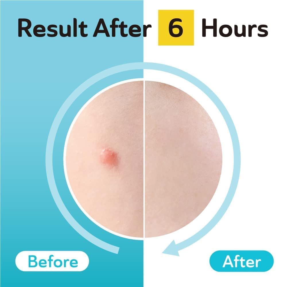 DERMA ANGEL Dark Spot Patches | Hydrocolloid, TXA & CICA – 132 Count (12mm) – Day & Night Use