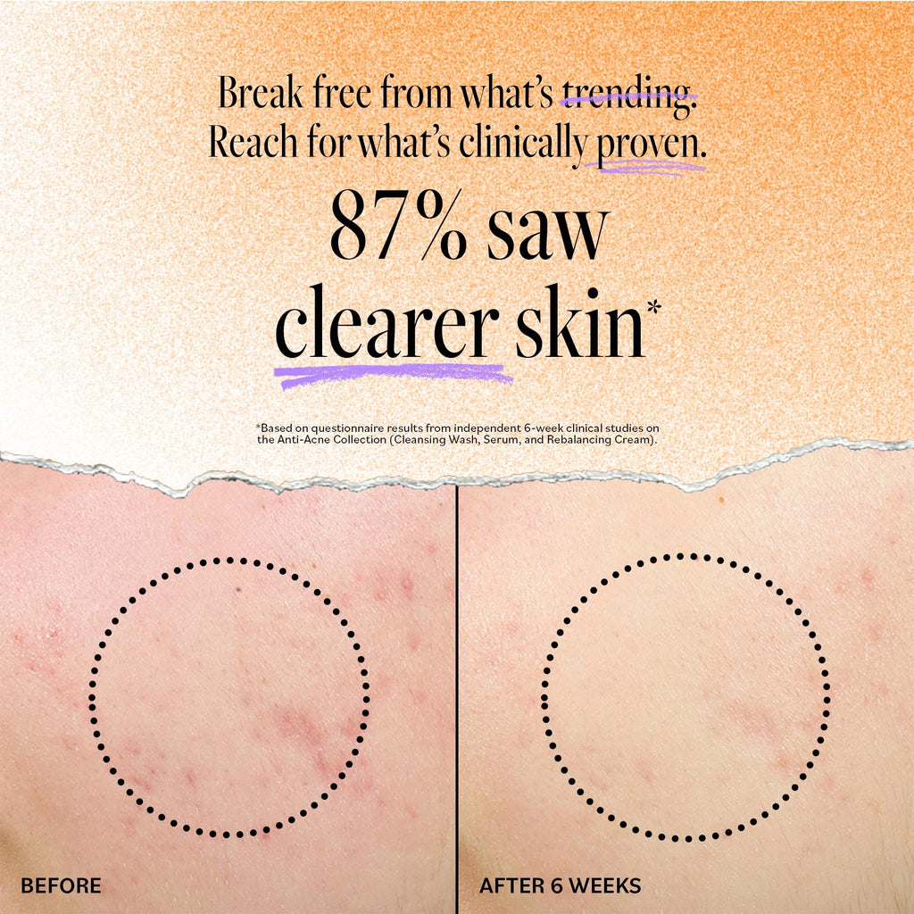 Derma E Acne Deep Pore Cleansing Wash – Salicylic Acid Face Cleanser for Clear Pores | 6 fl oz
