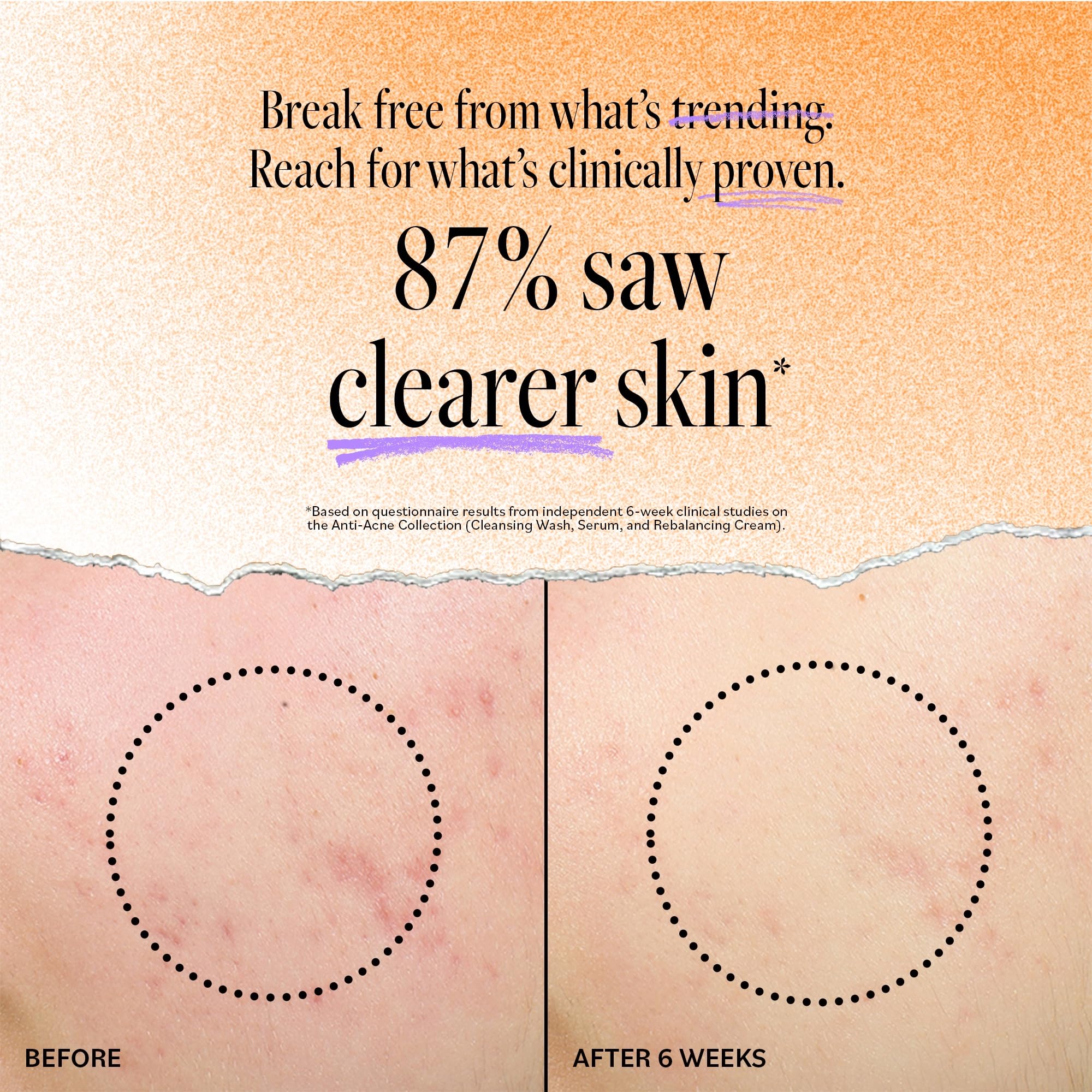 Derma E Acne Deep Pore Cleansing Wash – Salicylic Acid Face Cleanser for Clear Pores | 6 fl oz