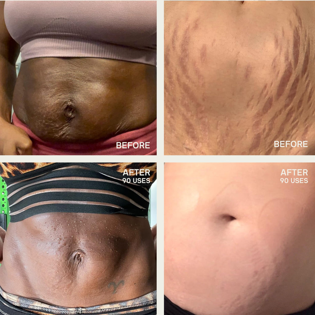 Dermaclara Large Silicone Body Patch – Pregnancy Stretch Marks & C‑Section Scar Coverage | Reusable 30x