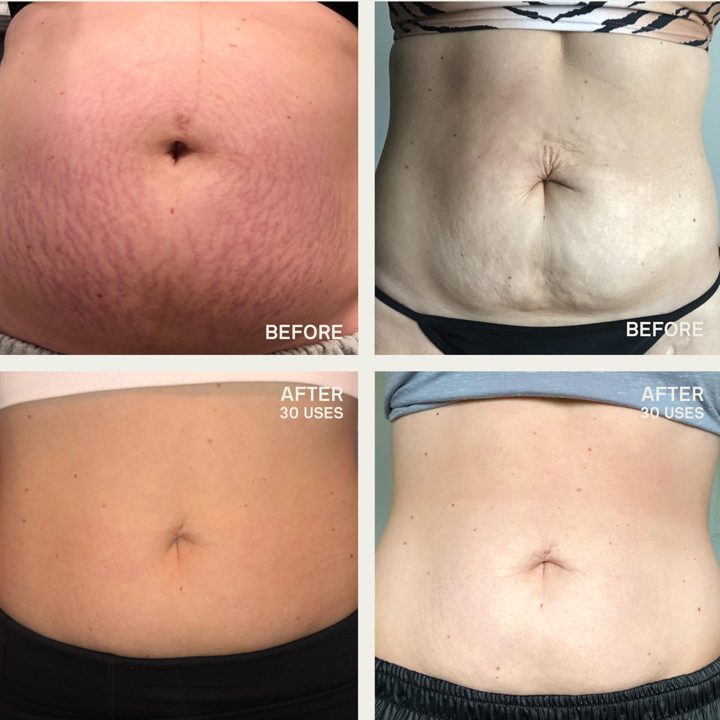 Dermaclara Large Silicone Body Patch – Pregnancy Stretch Marks & C‑Section Scar Coverage | Reusable 30x