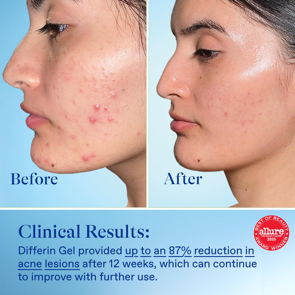 Differin Acne Treatment Gel 0.1% Adapalene – 30 Day Supply, 15g Pump (Packaging May Vary)