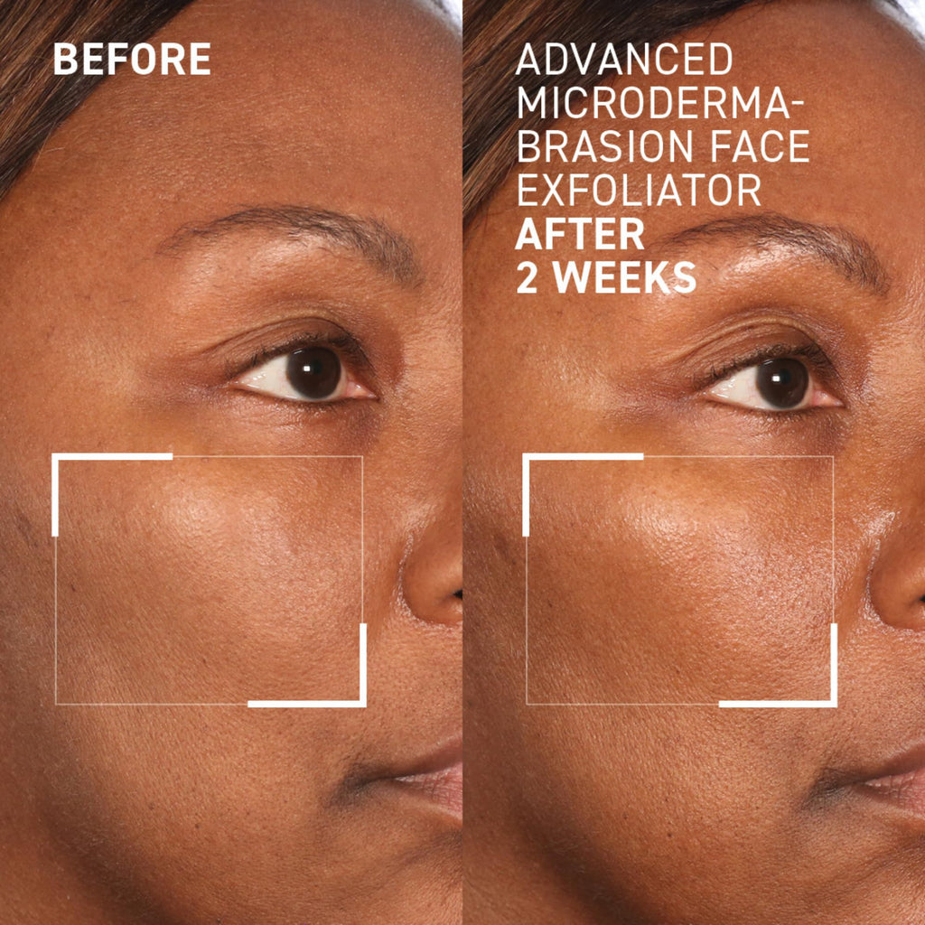 Dr. Brandt Advanced Microdermabrasion Face Exfoliator – Refines Texture & Evens Skin Tone | 2 oz