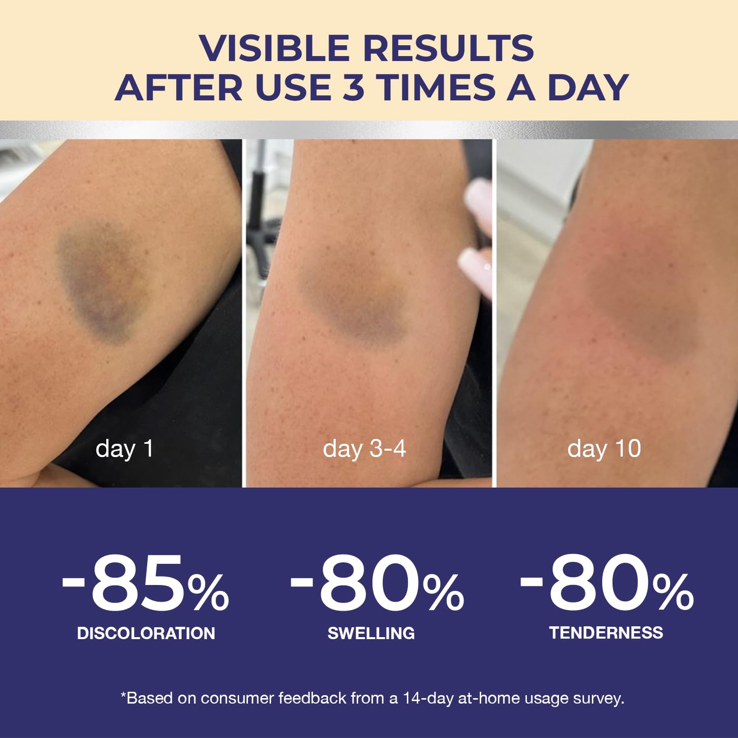 Dr. Luke Arnica Bruise Cream Extra Strength – Fast Relief for Bruising, Swelling & Discoloration