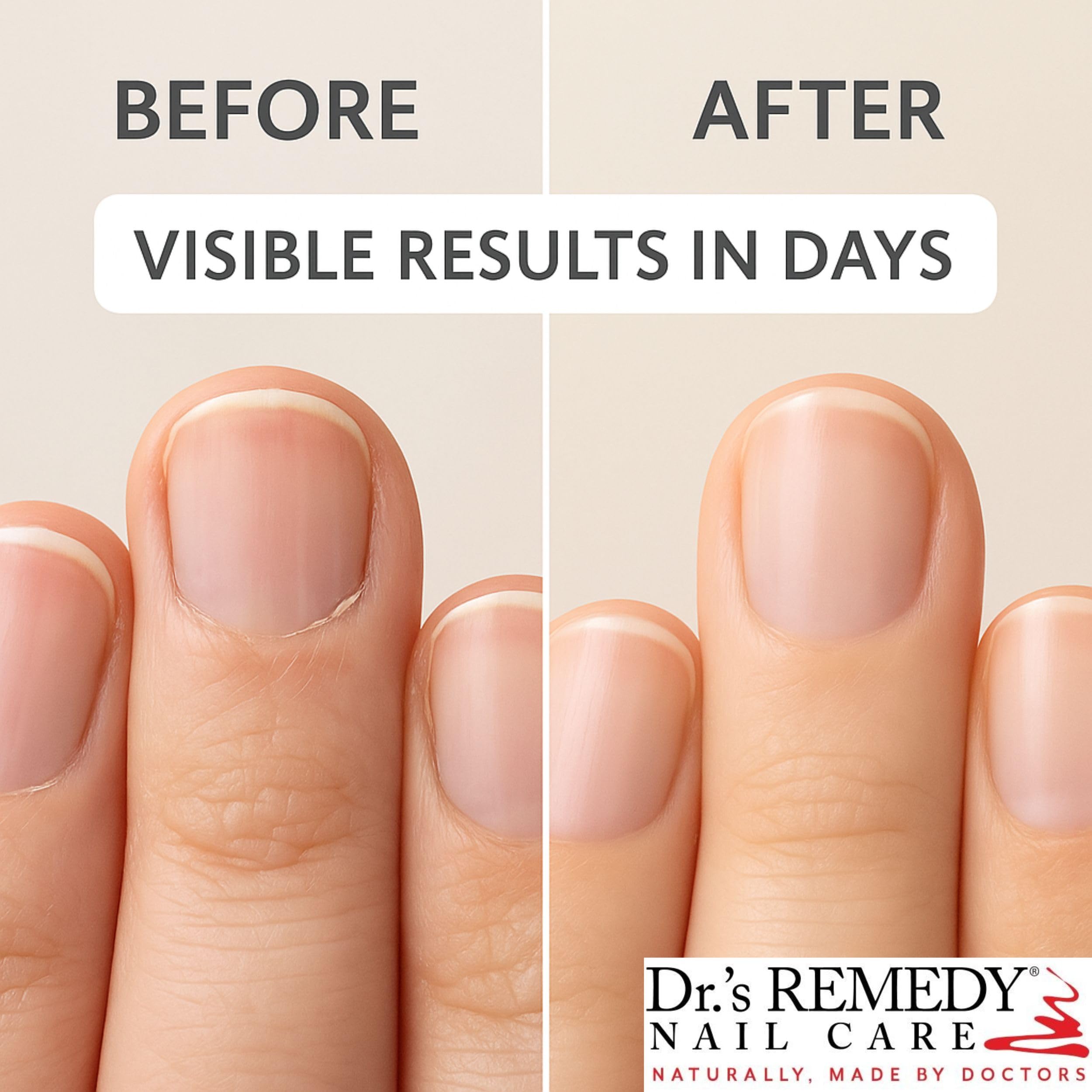 Dr.'s Remedy Therapeutic Caress Cuticle Oil – Nourishing Nail Treatment (0.507 Fl Oz)