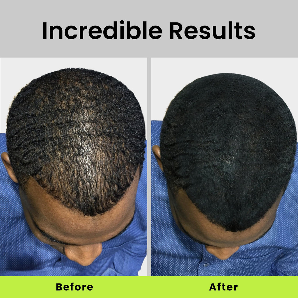 Eclipse Hair Fibers Dark Blonde – 30g Instant Thinning Hair Concealer for Women & Men