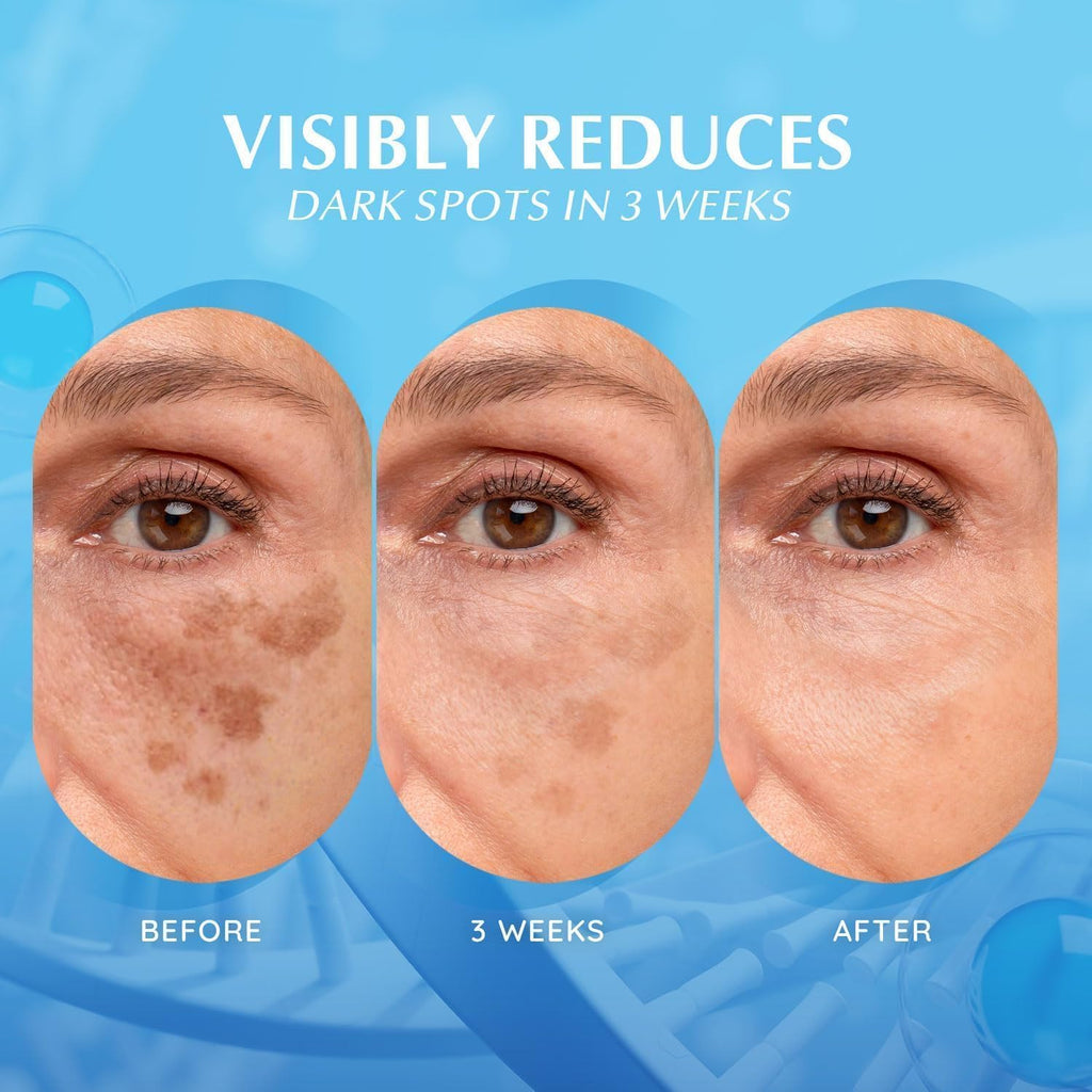 EnaSkin Dark Spot Remover Serum – Hyperpigmentation & Freckles (1 oz)