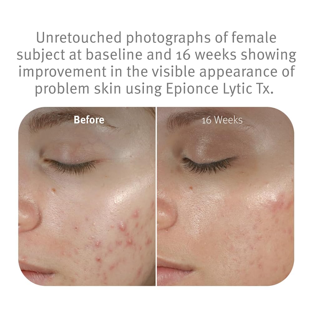 Epionce Lytic Tx - Gentle Acne-Prone Skin Care with Salicylic & Azelaic Acids