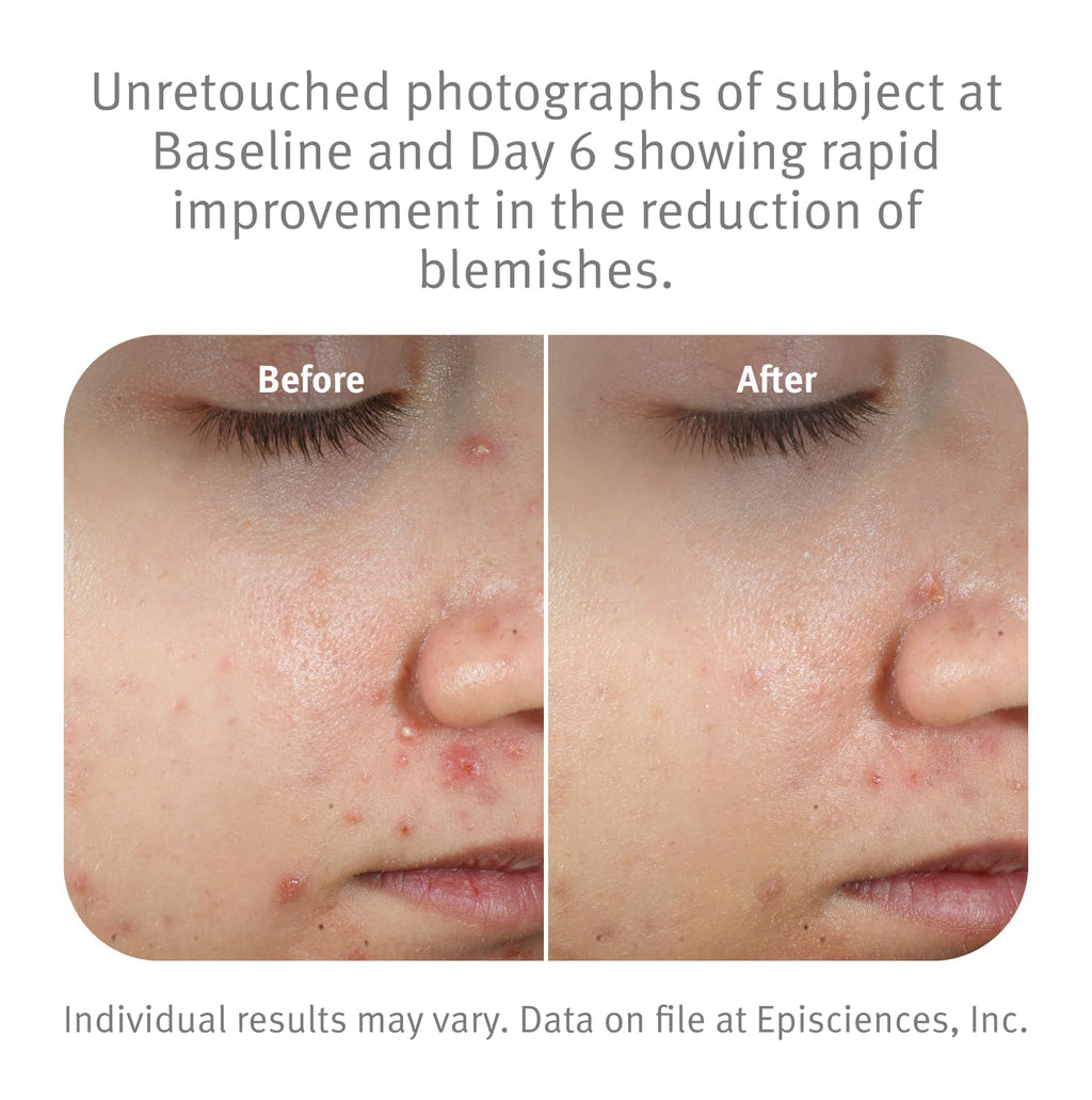 Epionce Blemish-Clearing Purifying Spot Gel | Fast-Acting Acne & Pore-Clearing for Face & Body