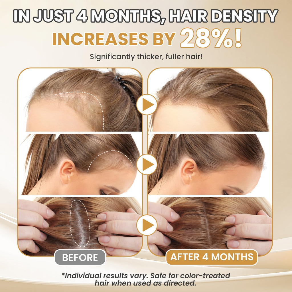 ETOVO 5% Minoxidil for Women – Hair Growth Serum for Thicker, Fuller Hair
