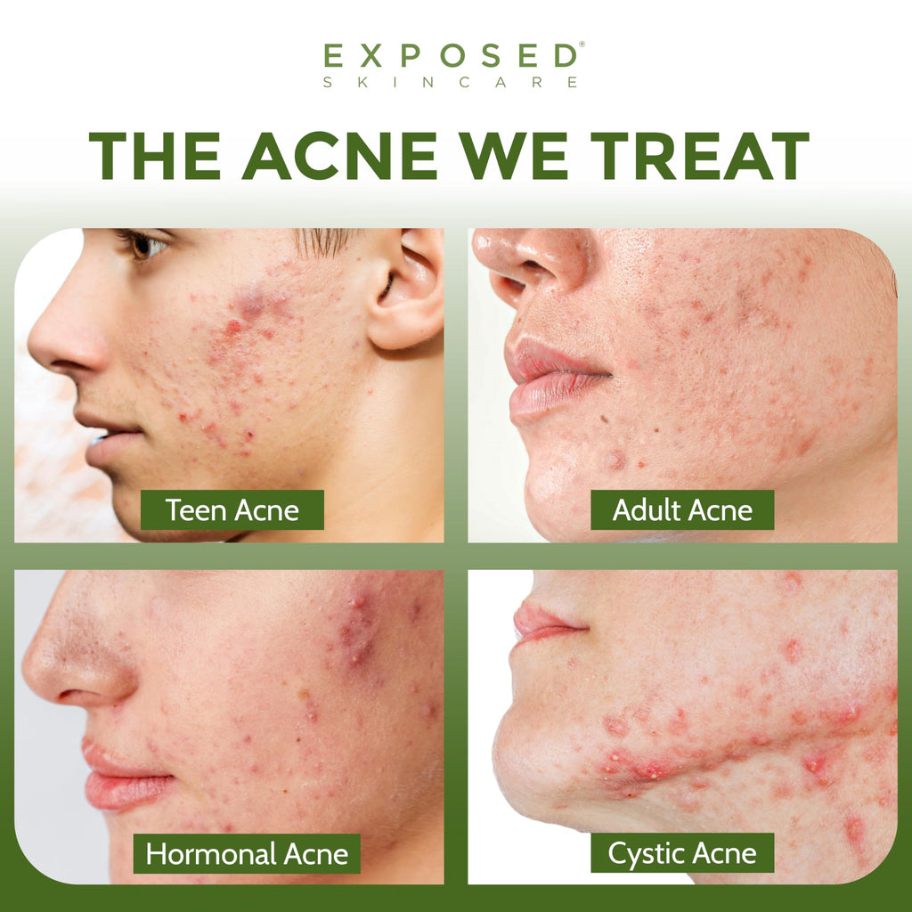 Exposed Skin Care Basic Acne Treatment Kit — 2.5% Salicylic Acid + 3.5% Benzoyl Peroxide