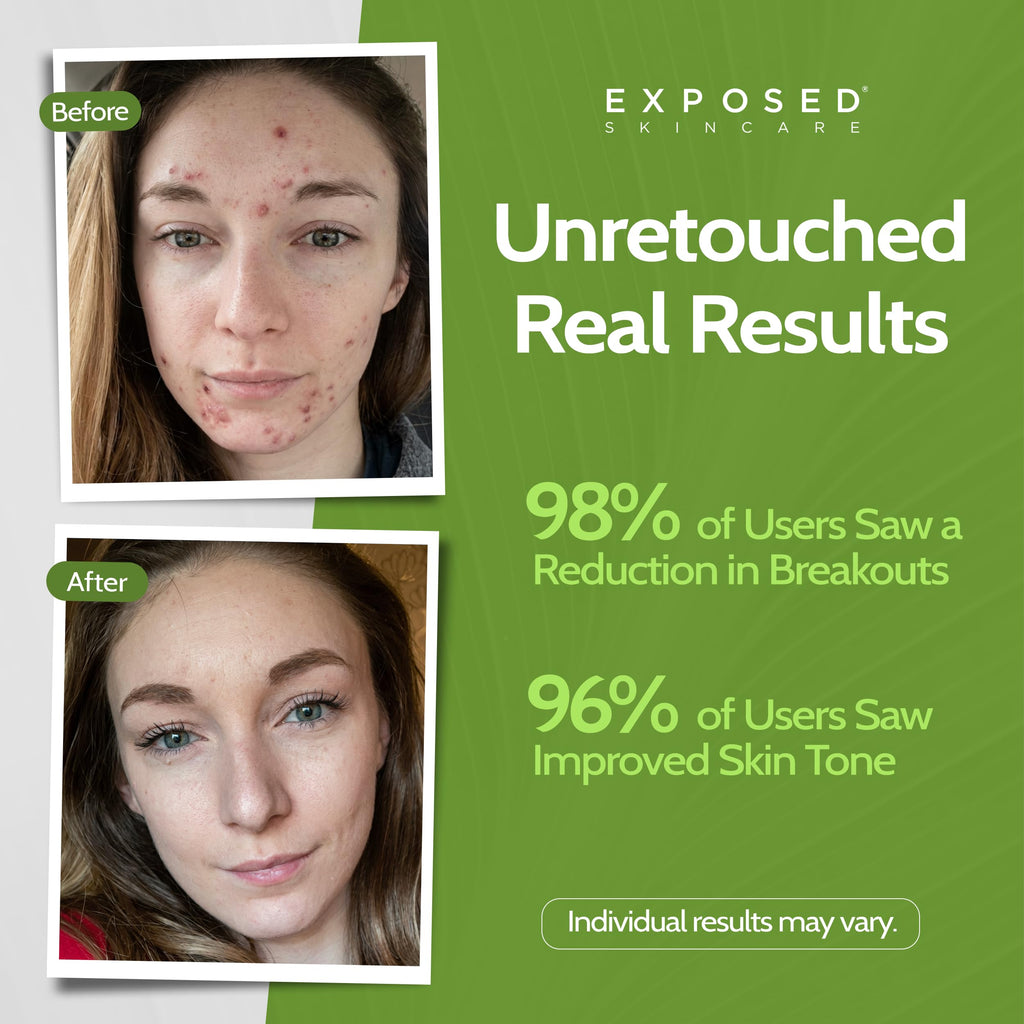 Exposed Skin Care Basic Acne Treatment Kit — 2.5% Salicylic Acid + 3.5% Benzoyl Peroxide